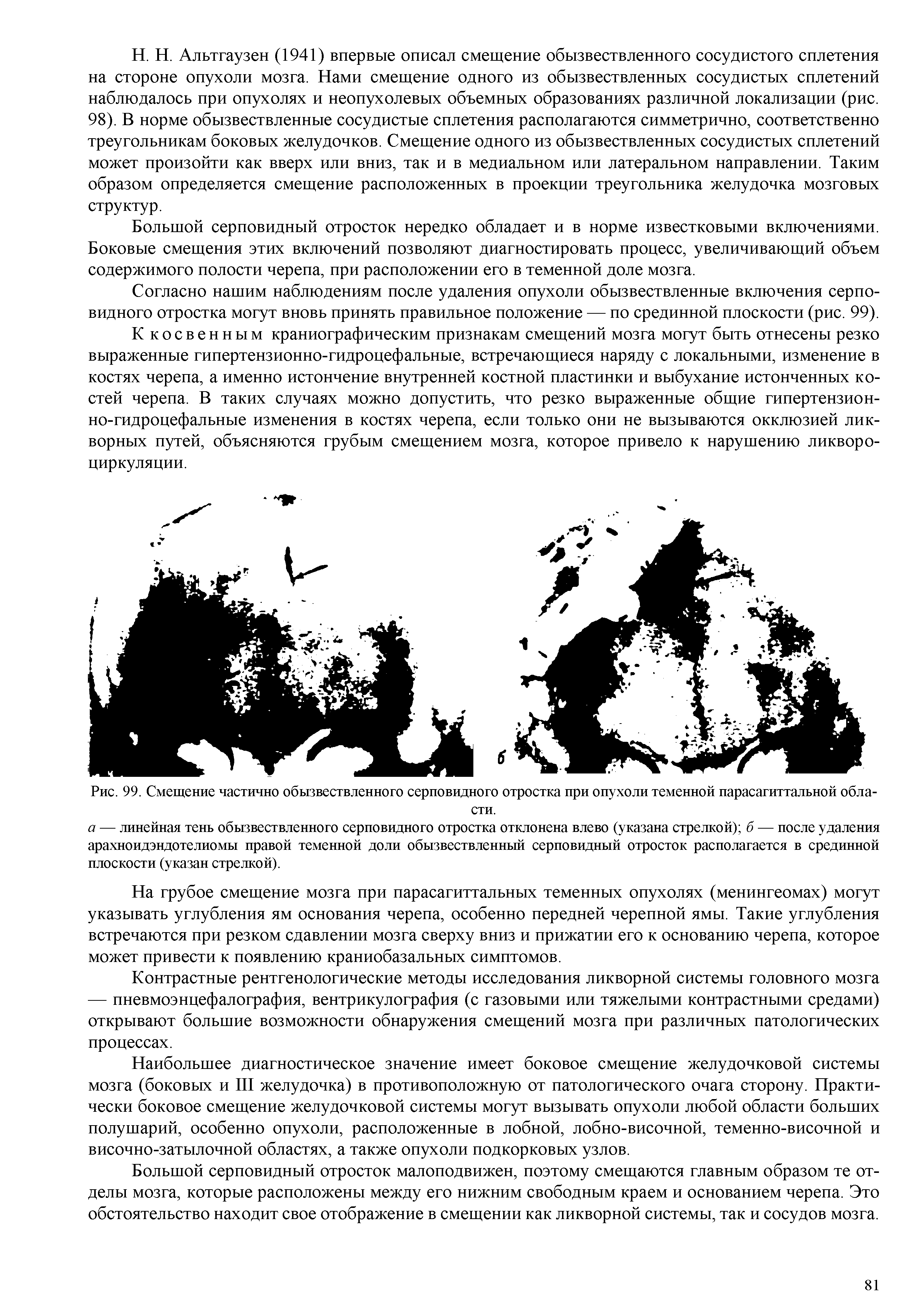 Рис. 99. Смещение частично обызвествленного серповидного отростка при опухоли теменной парасагиттальной области.