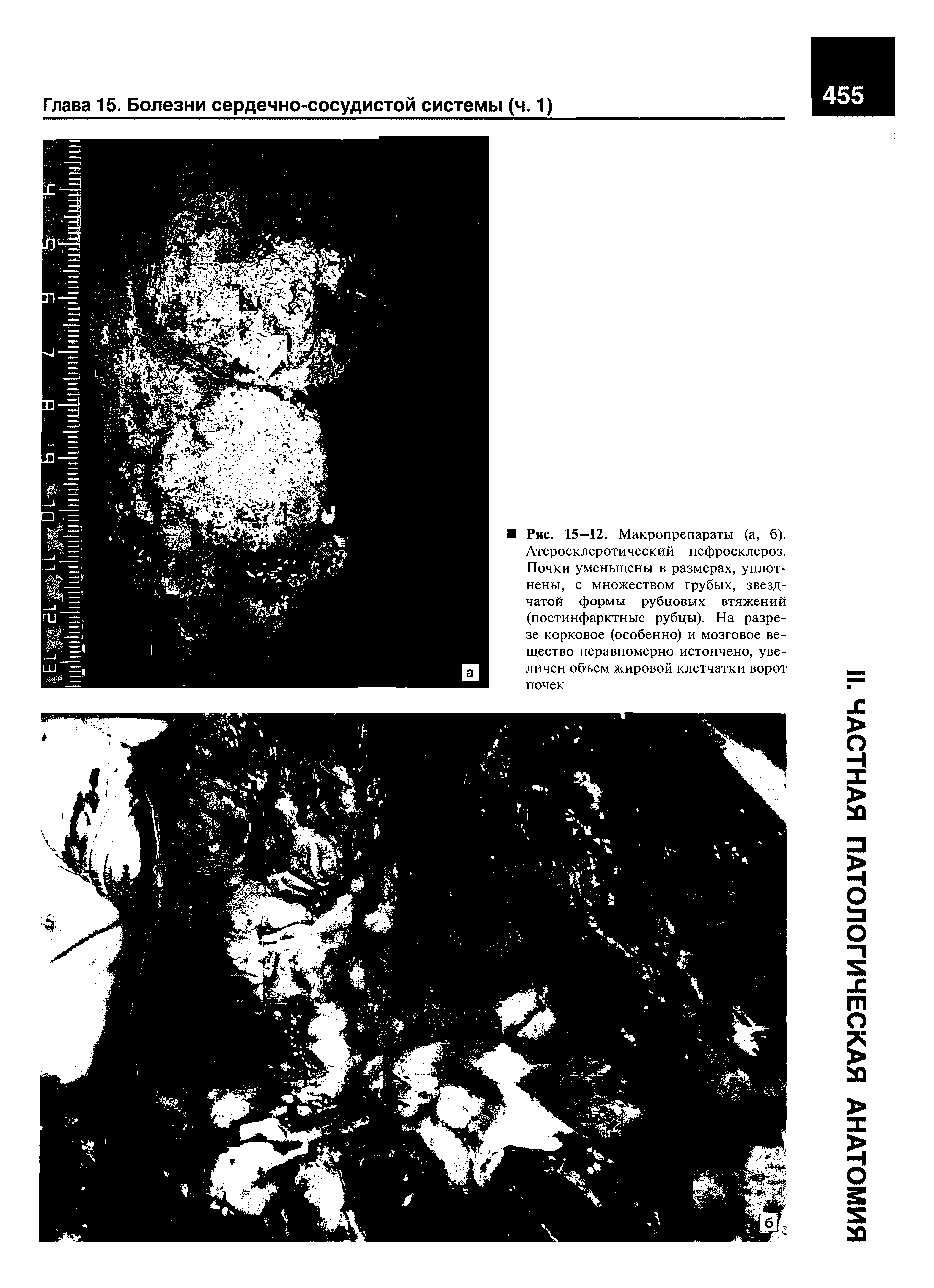 Рис. 15—12. Макропрепараты (а, б). Атеросклеротический нефросклероз. Почки уменьшены в размерах, уплотнены, с множеством грубых, звездчатой формы рубцовых втяжений (постинфарктные рубцы). На разрезе корковое (особенно) и мозговое вещество неравномерно истончено, увеличен объем жировой клетчатки ворот почек...