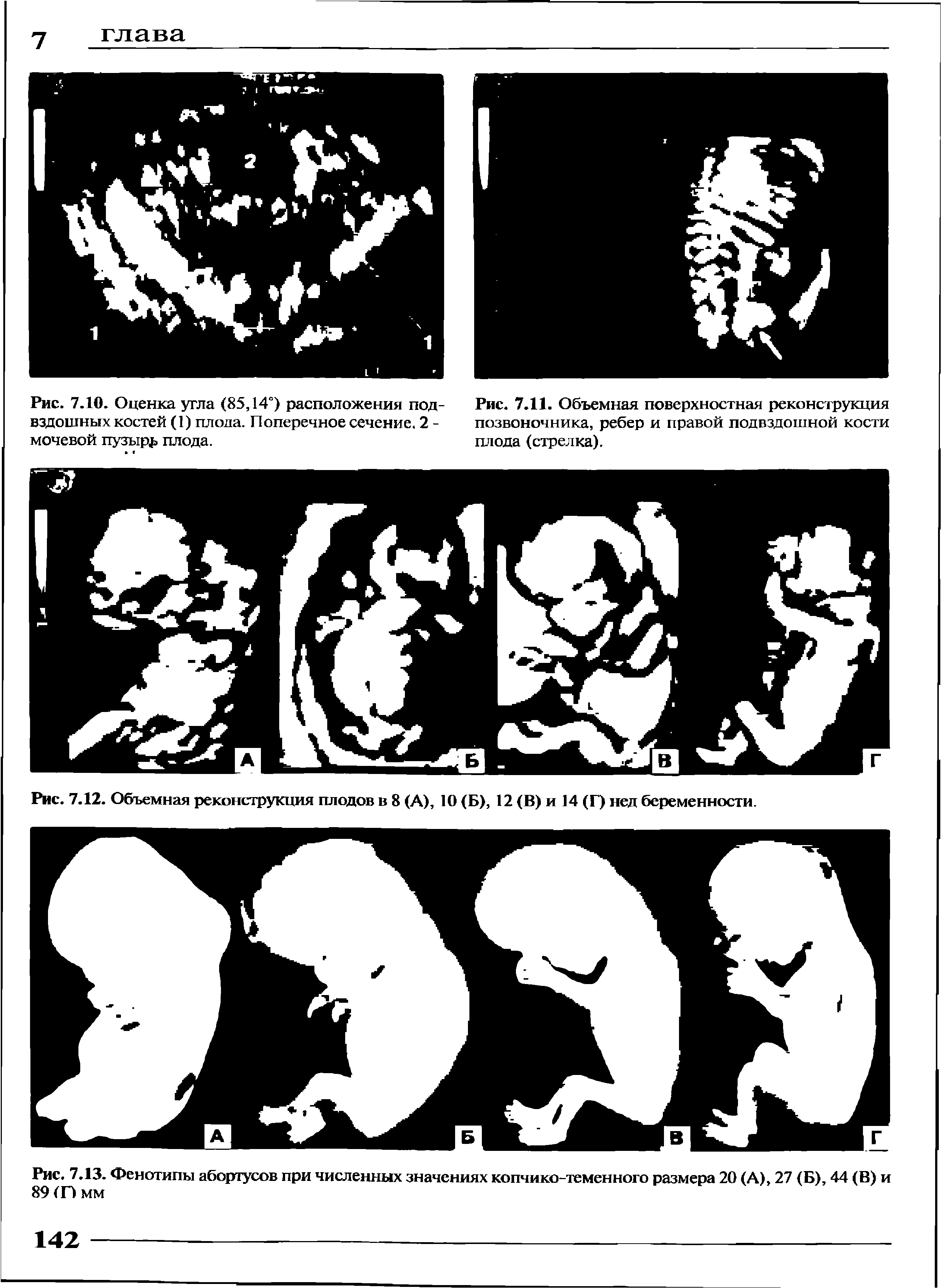 Рис. 7.13. Фенотипы абортусов при численных значениях копчико-теменного размера 20 (А), 27 (Б), 44 (В) и 89 (Г) мм...