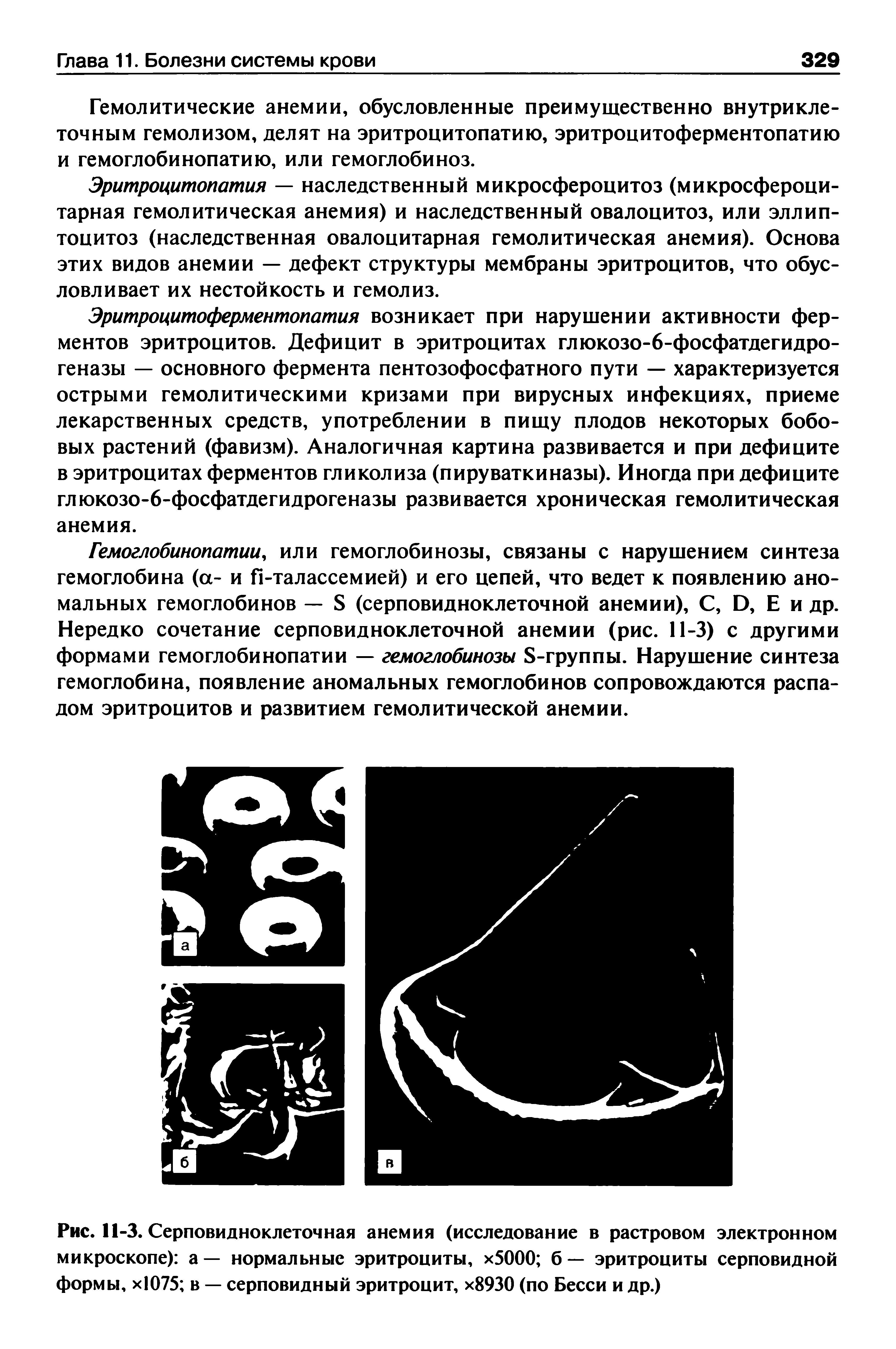 Рис. 11-3. Серповидноклеточная анемия (исследование в растровом электронном микроскопе) а — нормальные эритроциты, х5000 б — эритроциты серповидной формы, хЮ75 в — серповидный эритроцит, х8930 (по Бесси и др.)...