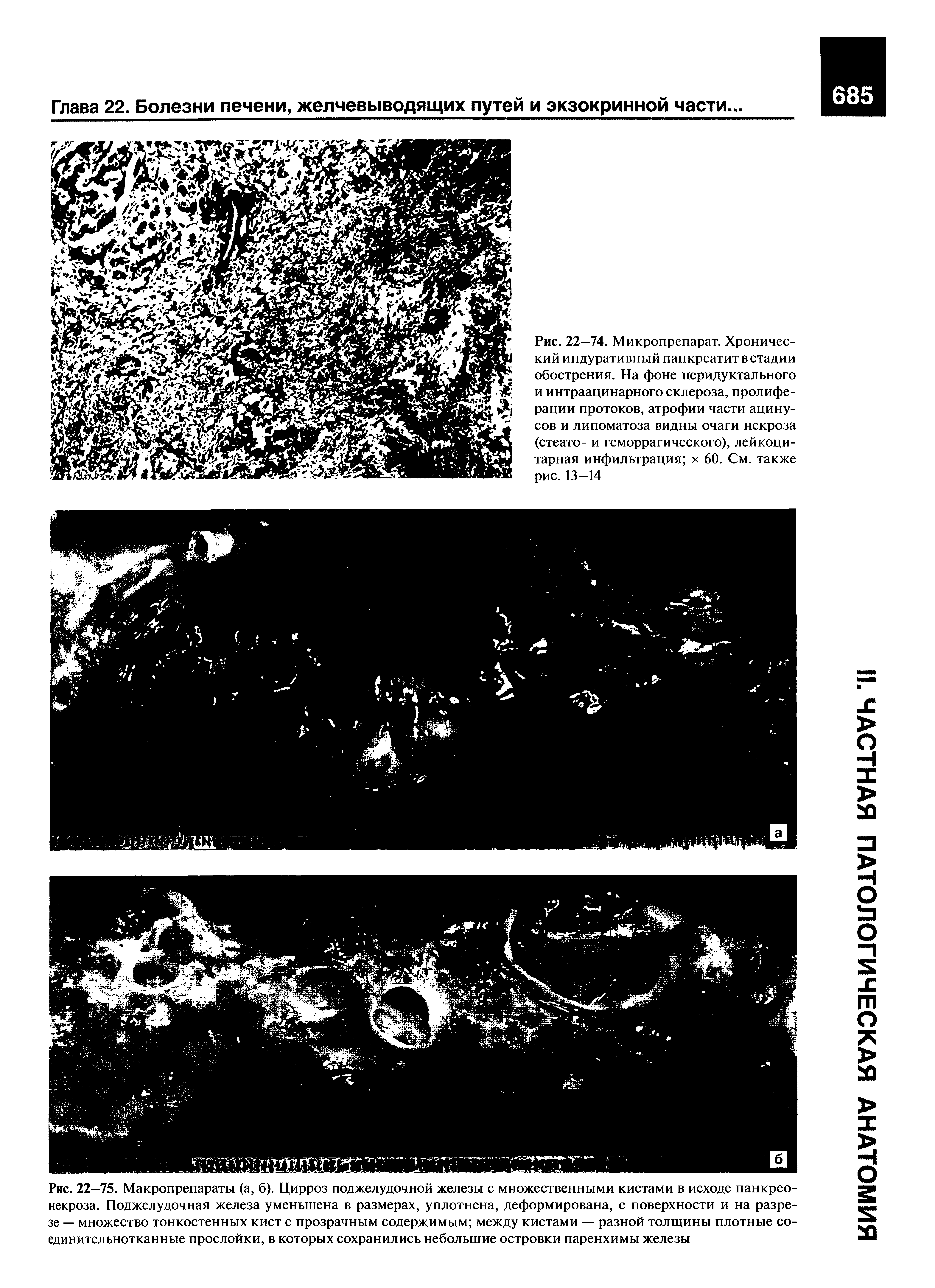 Рис. 22—74. Микропрепарат. Хронический индуративный панкреатит в стадии обострения. На фоне перидуктального и интраацинарного склероза, пролиферации протоков, атрофии части ацинусов и липоматоза видны очаги некроза (стеато- и геморрагического), лейкоцитарная инфильтрация х 60. См. также рис. 13-14...