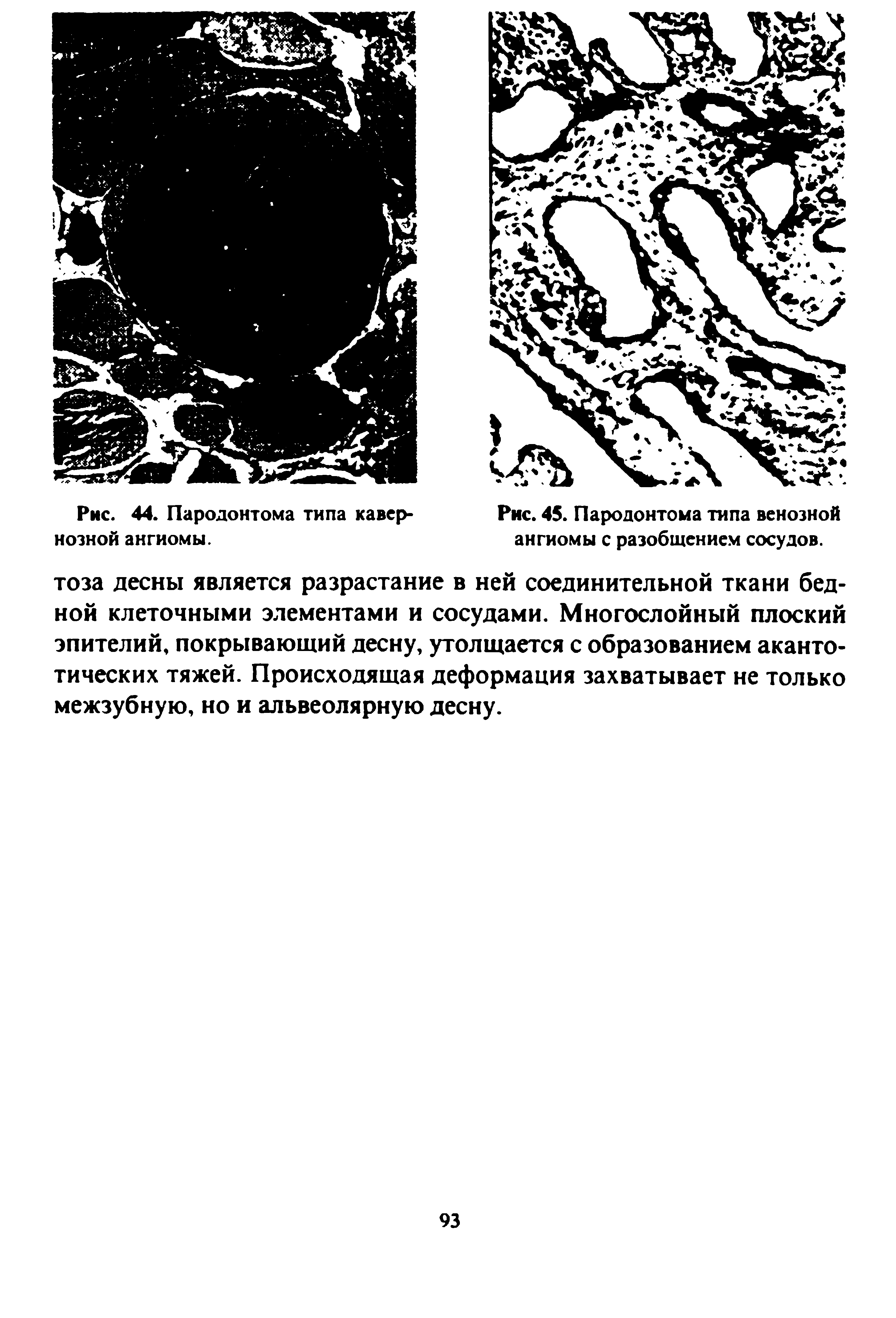 Рис. 45. Пародонтома типа венозной ангиомы с разобщением сосудов.