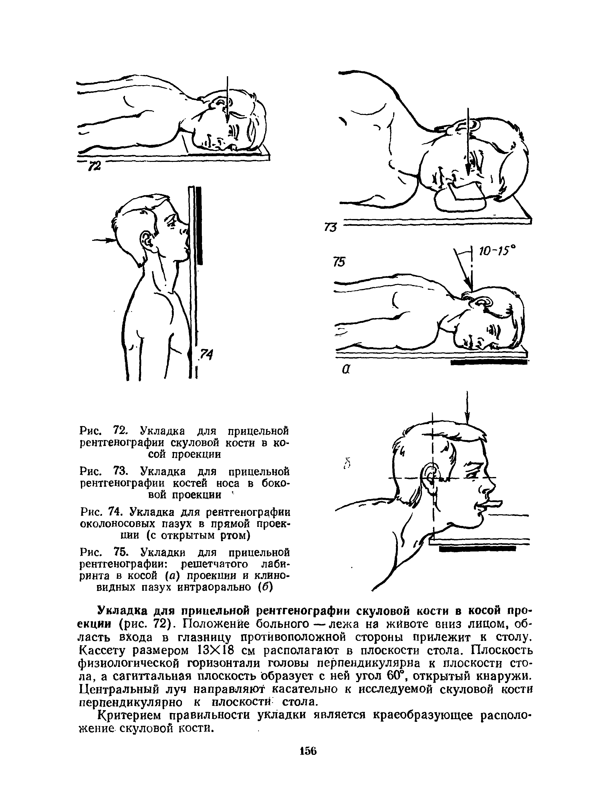 Рис. 75. Укладки для прицельной рентгенографии решетчатого лабиринта в косой (а) проекции и клиновидных пазух интраорально (б)...