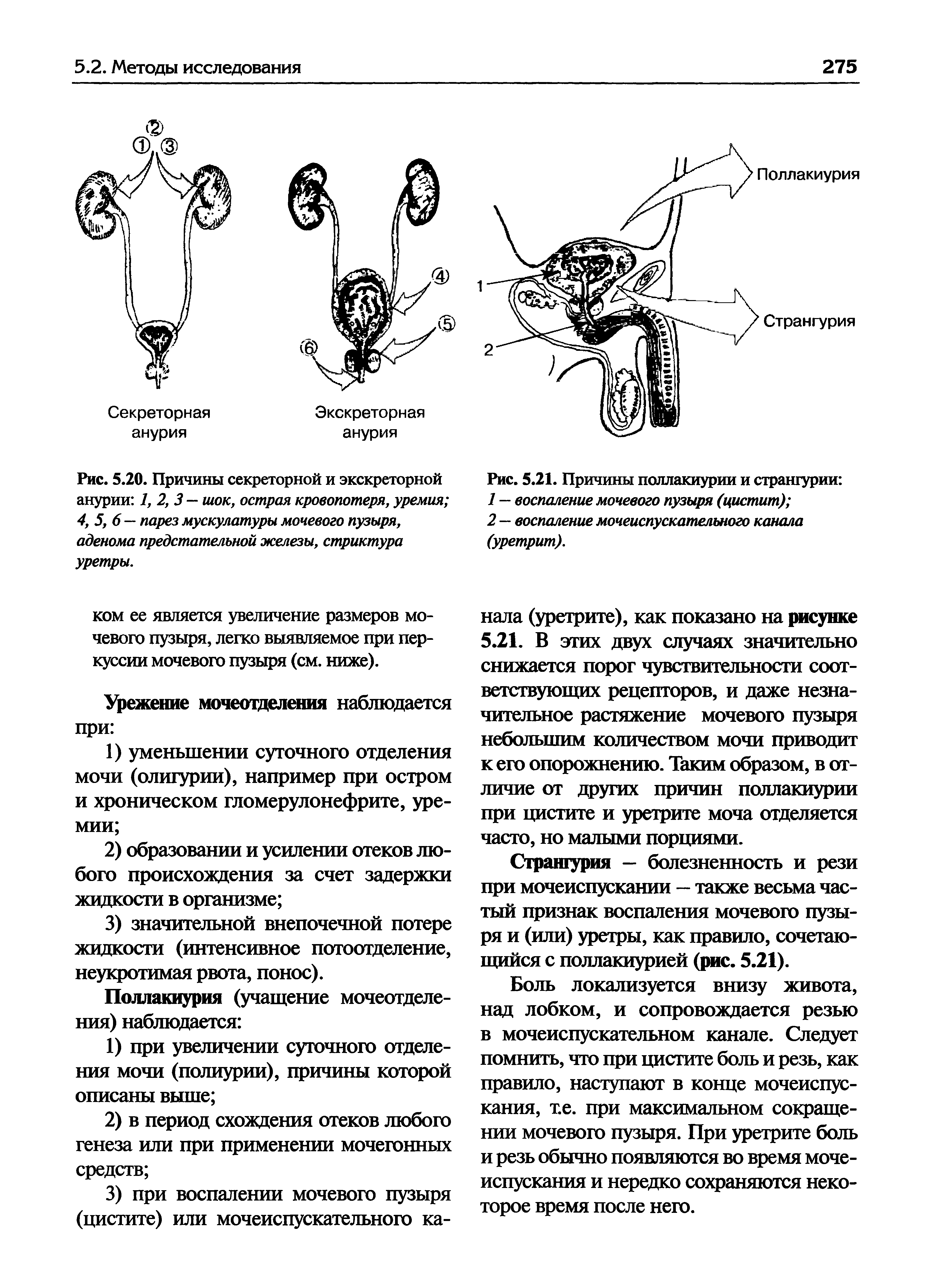 Рис. 5.20. Причины секреторной и экскреторной анурии 1, 2, 3 — шок, острая кровопотеря, уремия 4, 5, 6— парез мускулатуры мочевого пузыря, аденома предстательной железы, стриктура уретры.