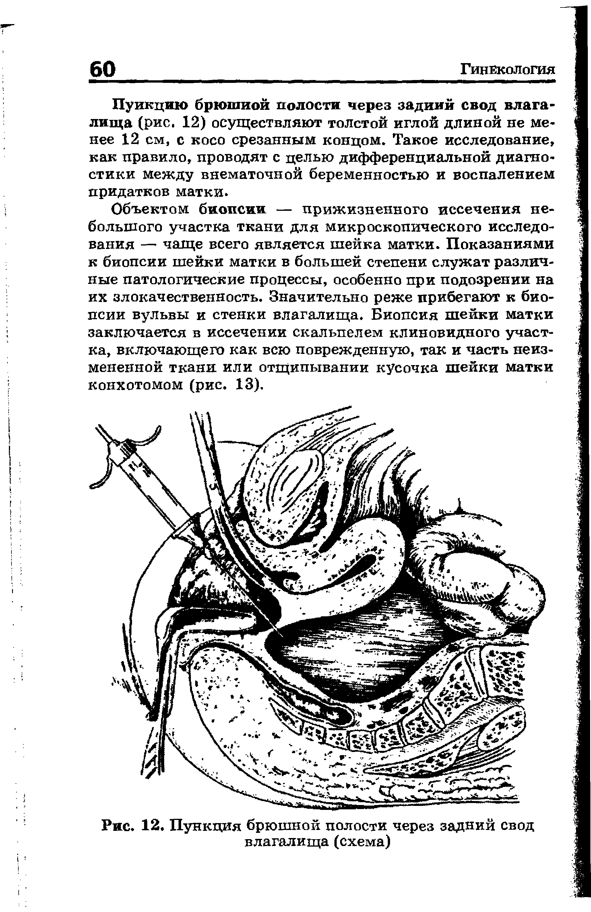 Рис. 12. Пункция брюшной полости через задний свод влагалища (схема)...