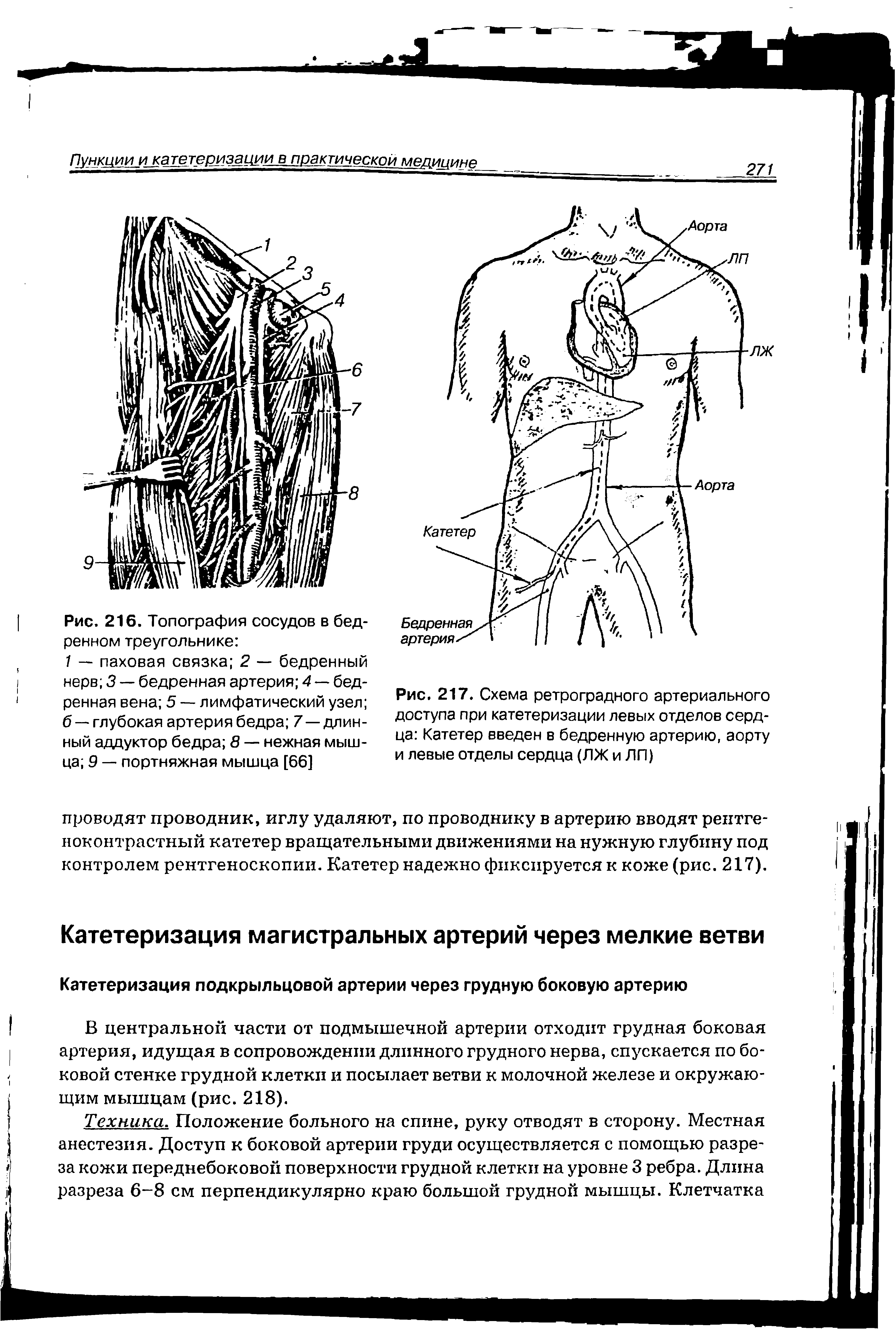 Рис. 217. Схема ретроградного артериального доступа при катетеризации левых отделов сердца Катетер введен в бедренную артерию, аорту и левые отделы сердца (ЛЖ и ЛП)...