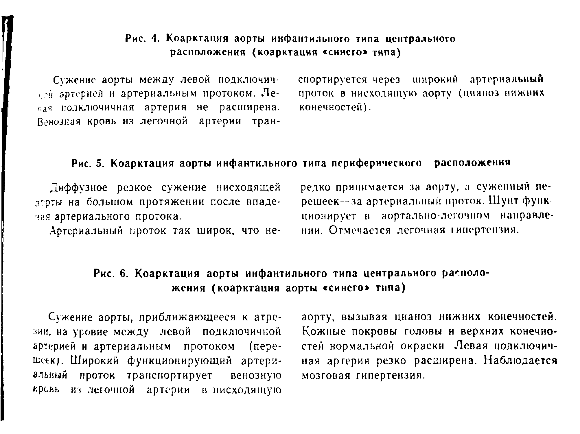 Рис. 5. Коарктация аорты инфантильного типа периферического расположения...