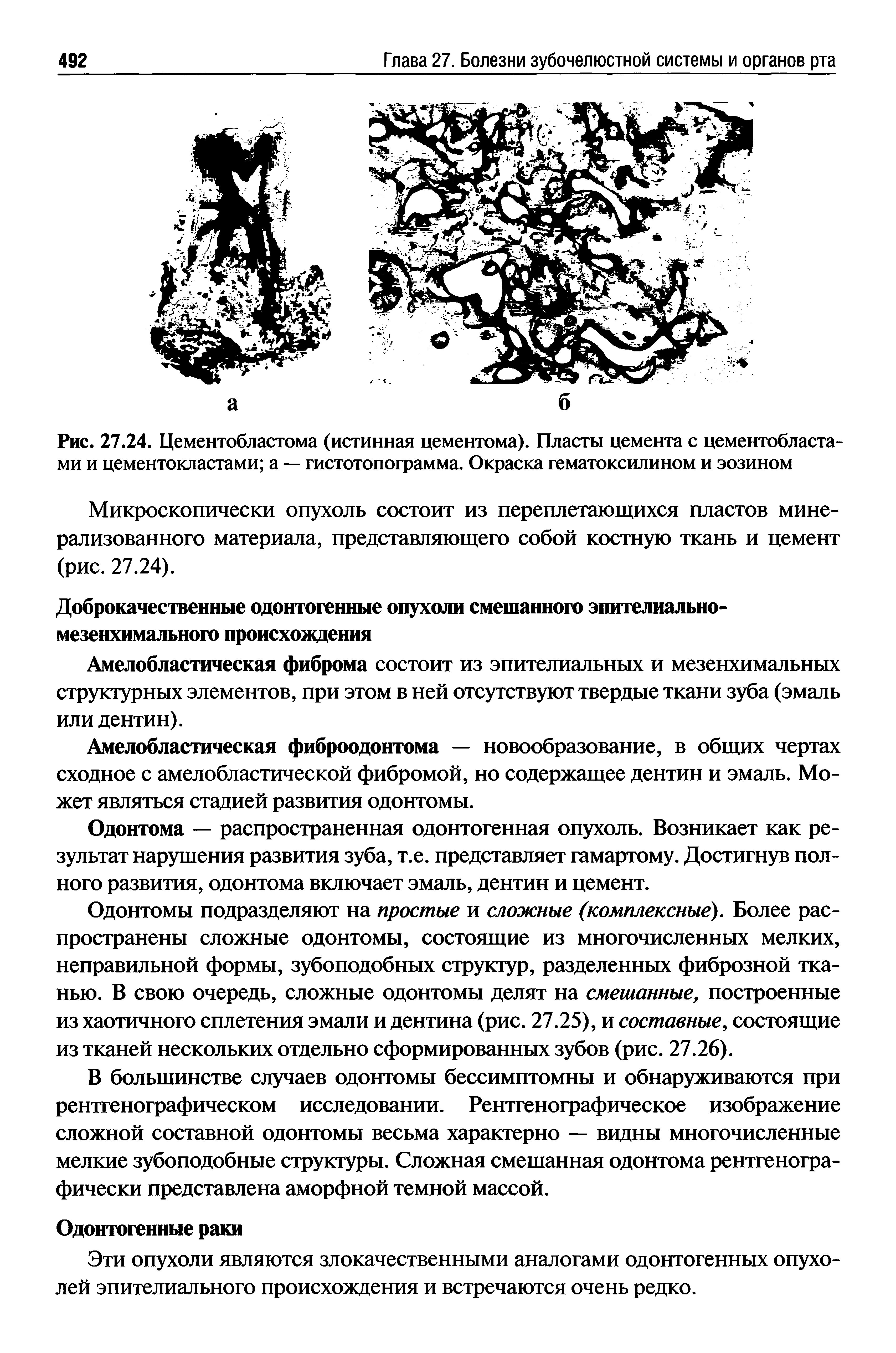 Рис. 27.24. Цементобластома (истинная цементома). Пласты цемента с цементобласта-ми и цементокластами а — гистотопограмма. Окраска гематоксилином и эозином...