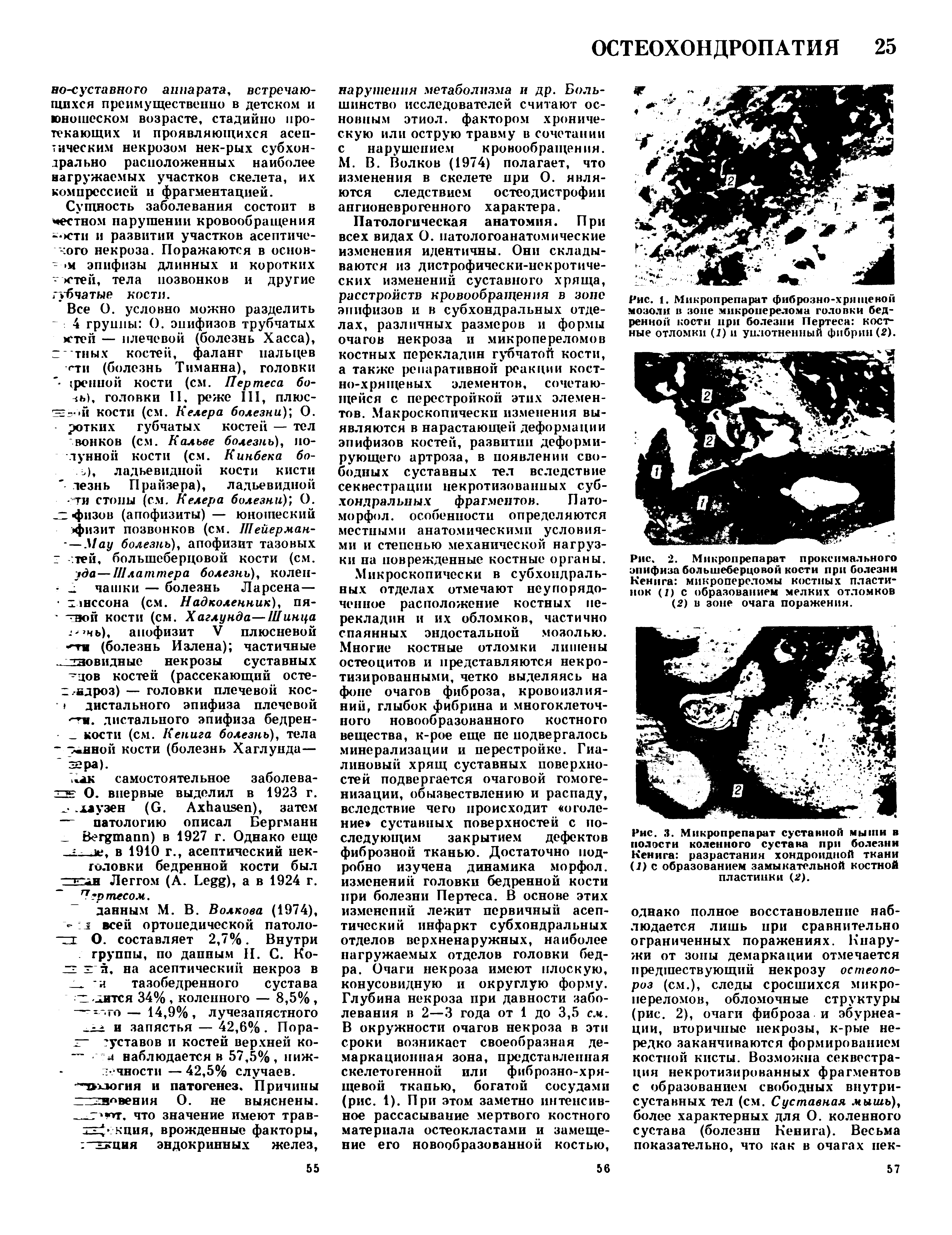 Рис. 2. Микропрепарат проксимального эпифиза большеберцовой кости при болезни Кенига микроперсломы костных пластинок (2) с образованием мелких отломков (2) в зоне очага поражения.