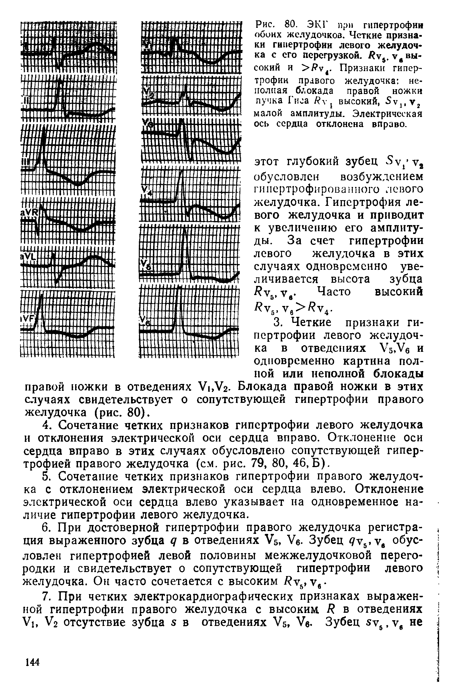 Рис. 80. ЭКГ при гипертрофии обоих желудочков. Четкие признаки гипертрофии левого желудочка с его перегрузкой. / у. у4 высокий и >/ у4. Признаки гипертрофии правого желудочка неполная блокада правой ножки пучка Гиса / у высокий, 5у],у2 малой амплитуды. Электрическая ось сердца отклонена вправо.