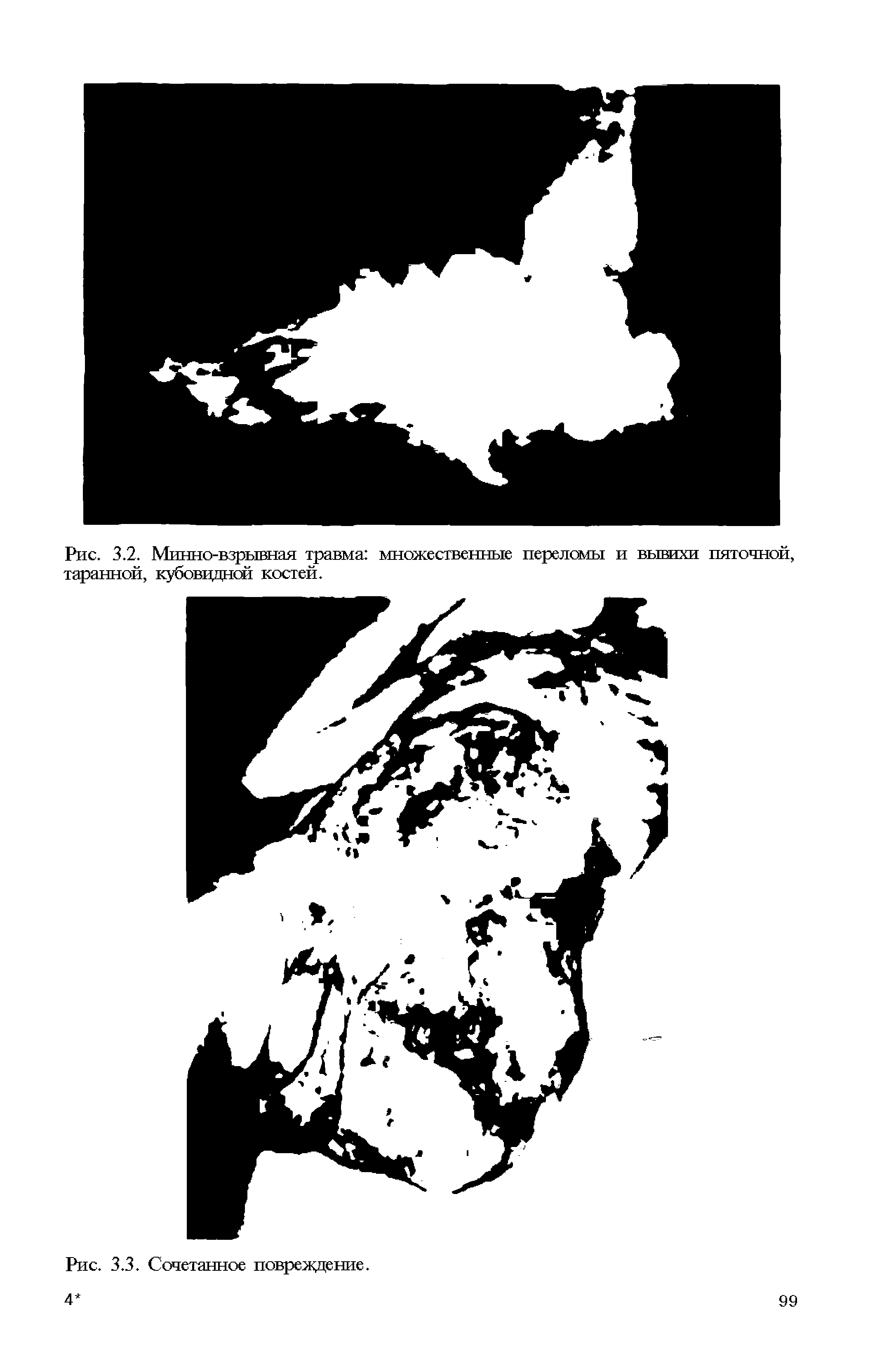 Рис. 3.2. Минно-взрывная травма множественные переломы и вывихи пяточной, таранной, кубовидной костей.