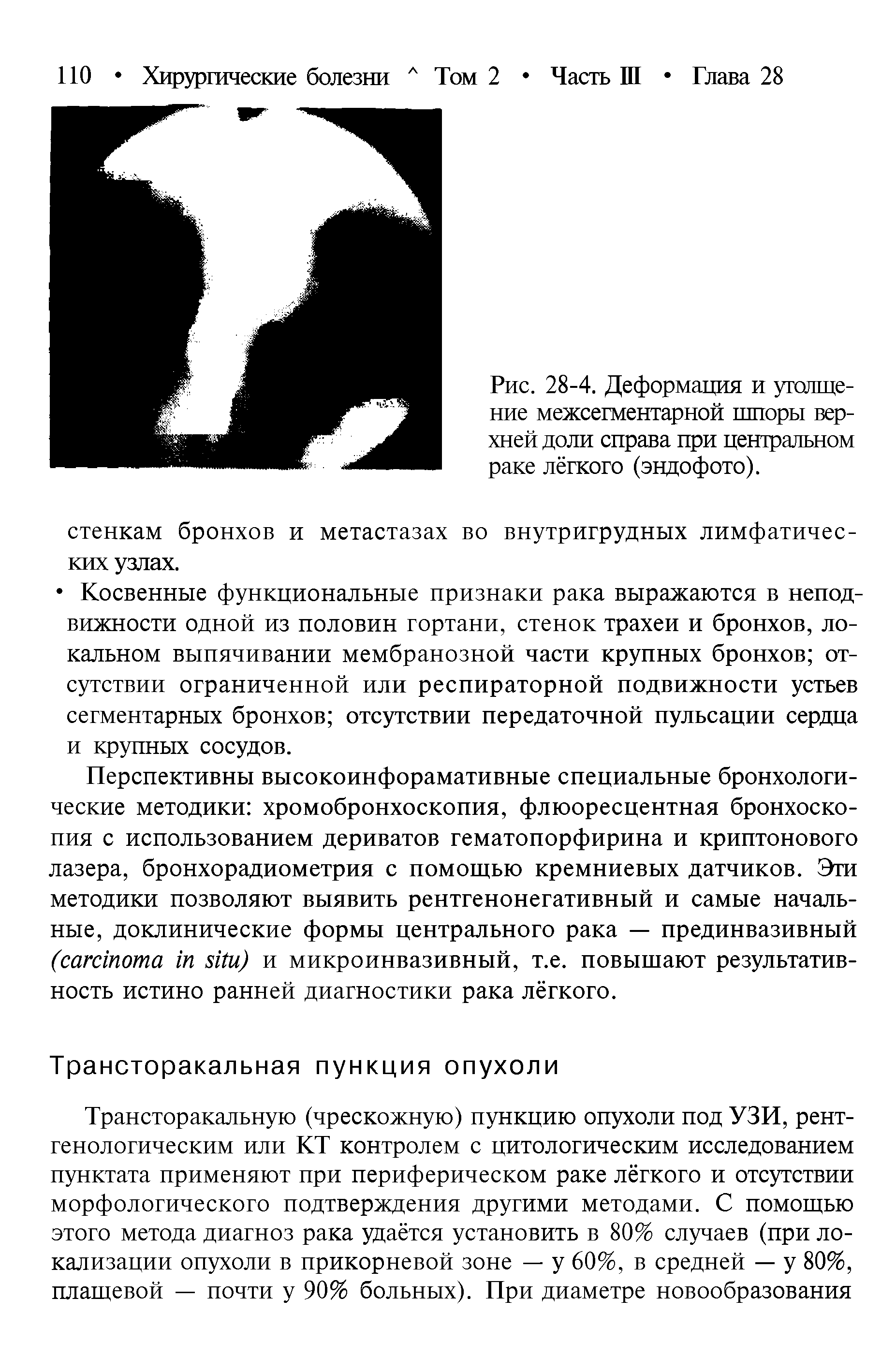 Рис. 28-4. Деформация и утолщение межсегментарной шпоры верхней доли справа при центральном раке лёгкого (эндофото).