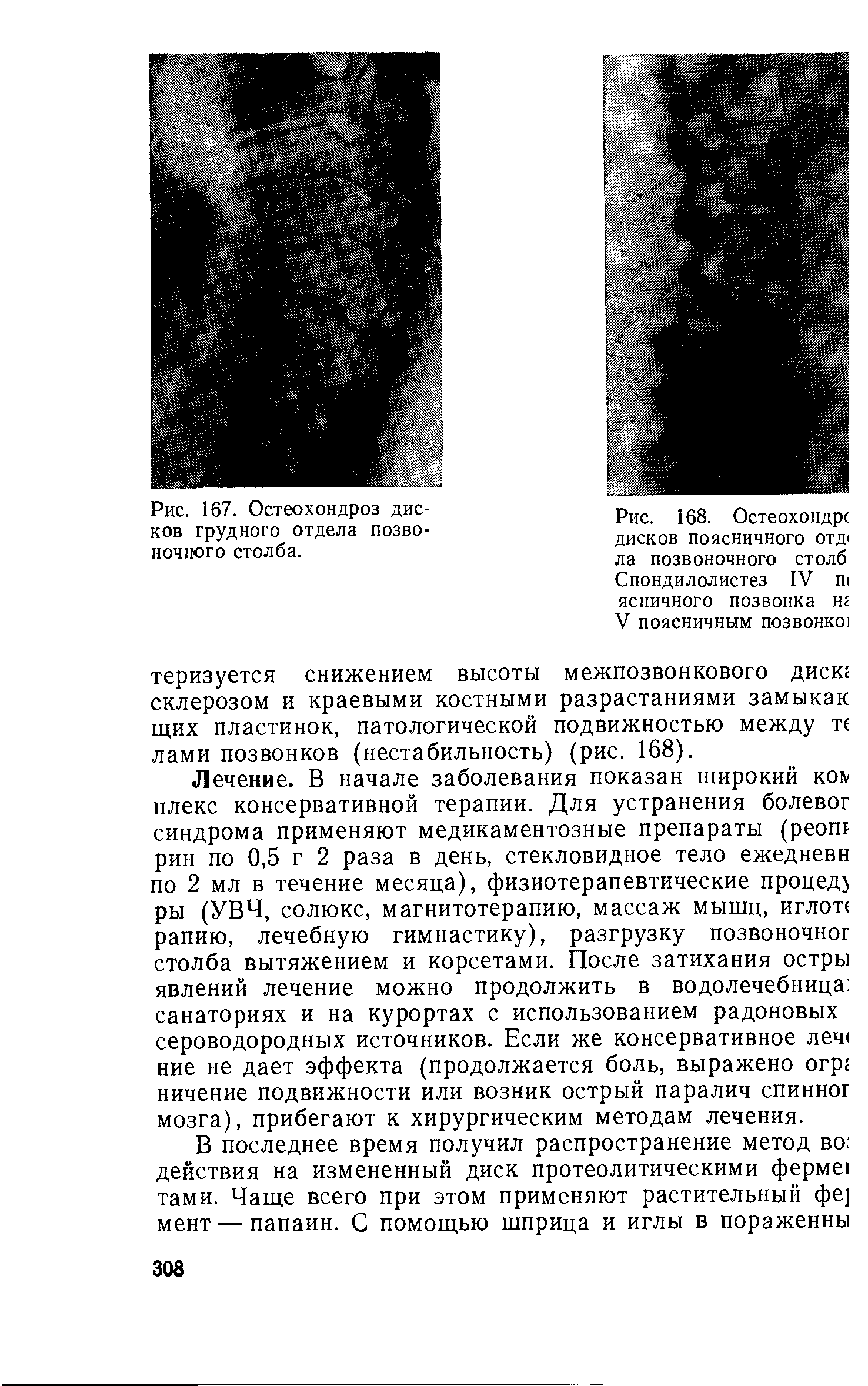 Рис. 168. Остеохондрс ДИСКОВ ПОЯСНИЧНОГО ОТД1 ла позвоночного столб Спондилолистез IV п< ясничного позвонка нг V ПОЯСНИЧНЫМ ПОЗВОНКО ...