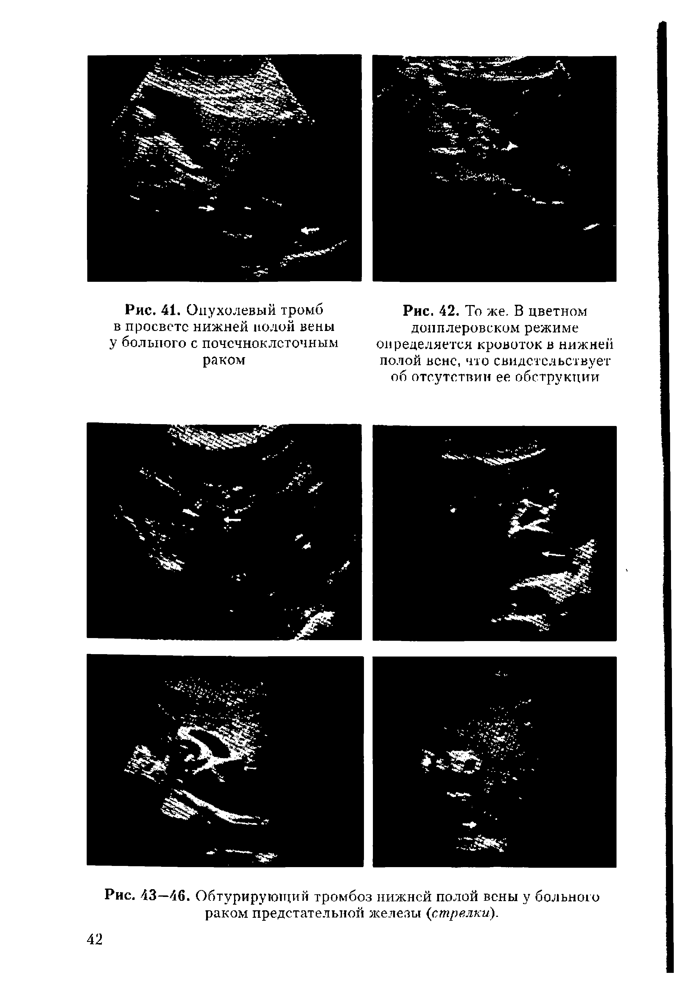 Рис. 43—46. Обтурирующий тромбоз нижней полой вены у больного раком предстательной железы (стрелки).