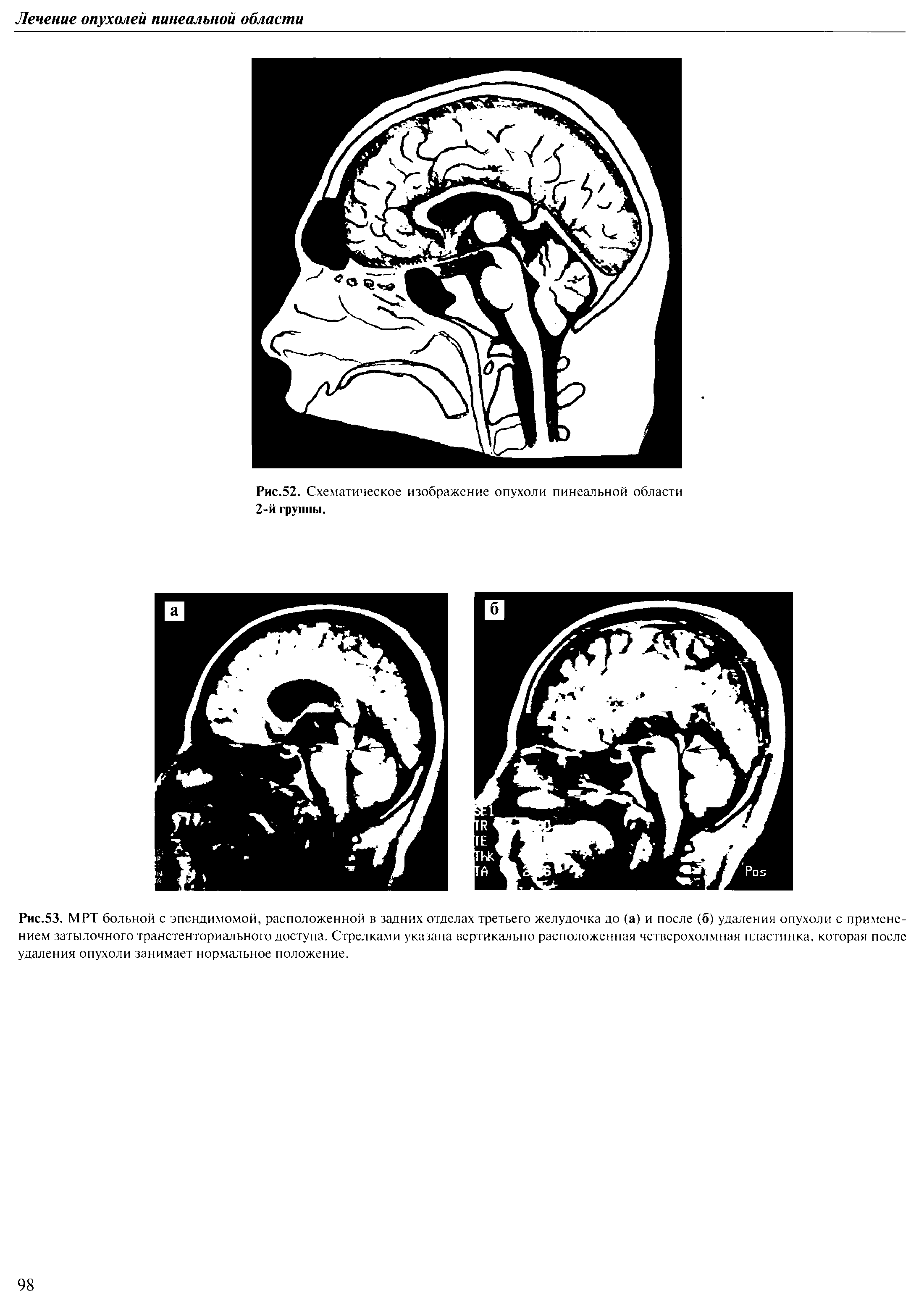 Рис.53. МРТ больной с эпендимомой, расположенной в задних отделах третьего желудочка до (а) и после (б) удаления опухоли с применением затылочного транстенториального доступа. Стрелками указана вертикально расположенная четверохолмная пластинка, которая после удаления опухоли занимает нормальное положение.