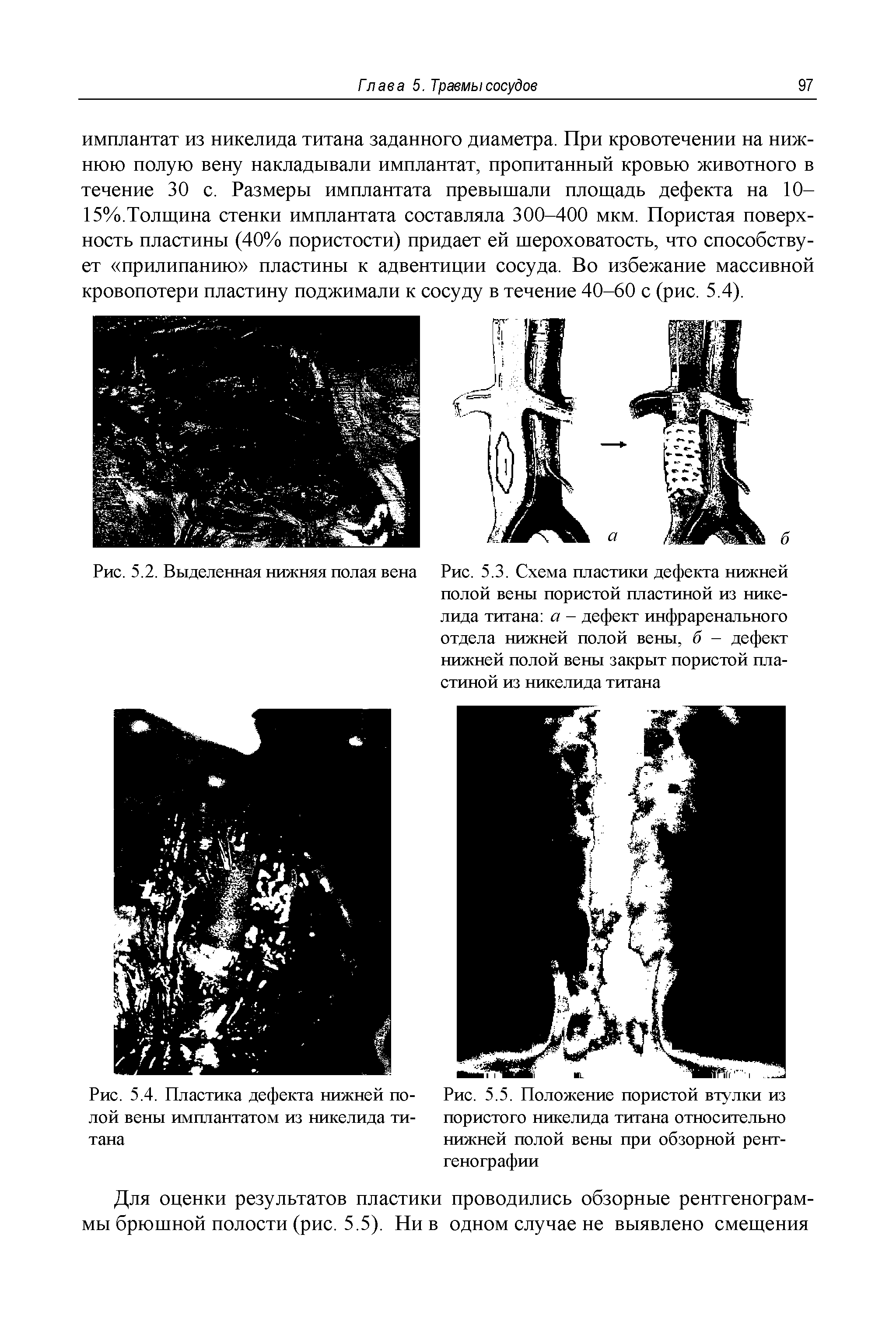 Рис. 5.4. Пластика дефекта нижней полой вены имплантатом из никелида титана...