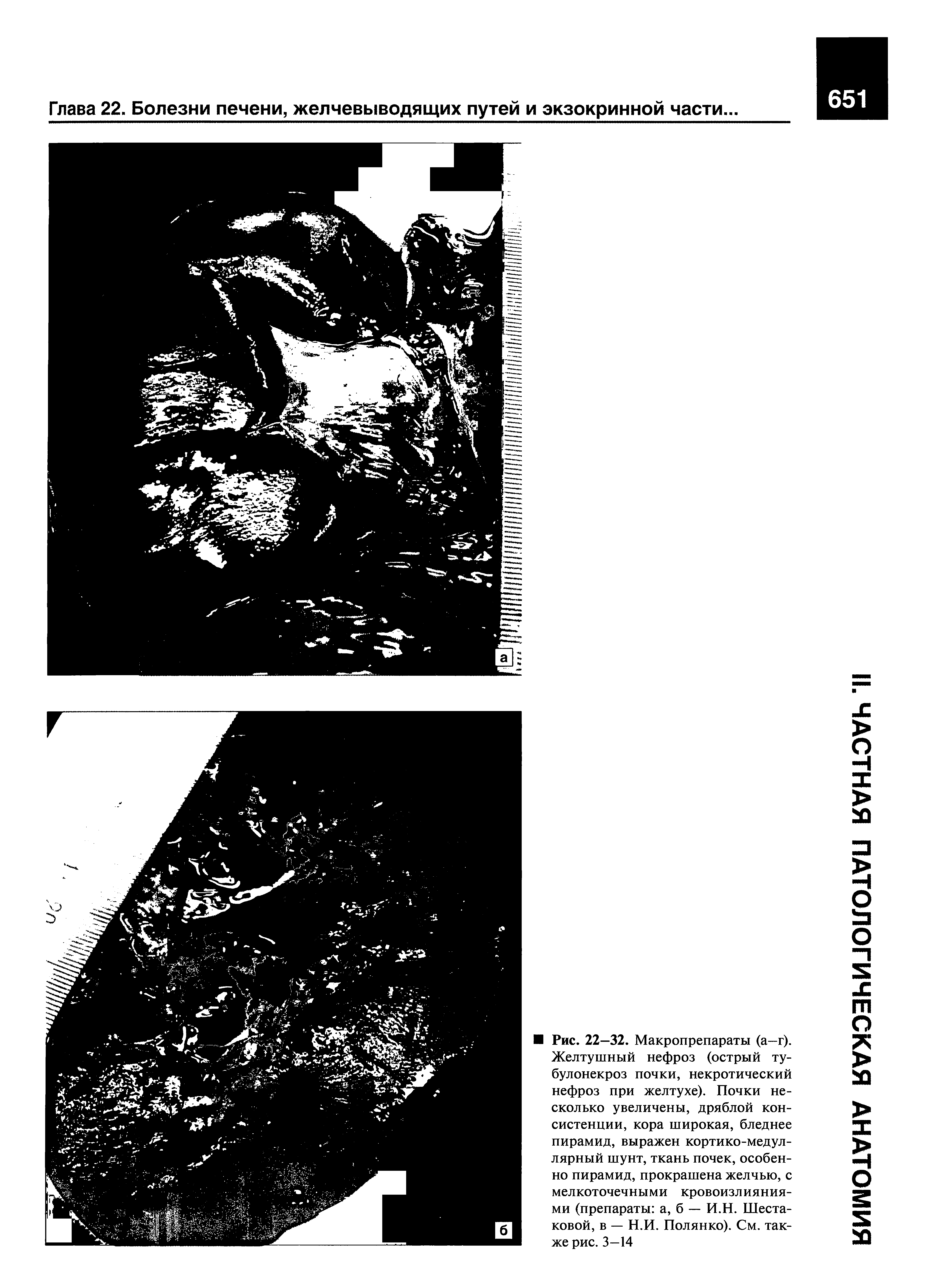 Рис. 22—32. Макропрепараты (а—г). Желтушный нефроз (острый ту-булонекроз почки, некротический нефроз при желтухе). Почки несколько увеличены, дряблой консистенции, кора широкая, бледнее пирамид, выражен кортико-медуллярный шунт, ткань почек, особенно пирамид, прокрашена желчью, с мелкоточечными кровоизлияниями (препараты а, б — И.Н. Шестаковой, в — Н.И. Полянко). См. также рис. 3—14...