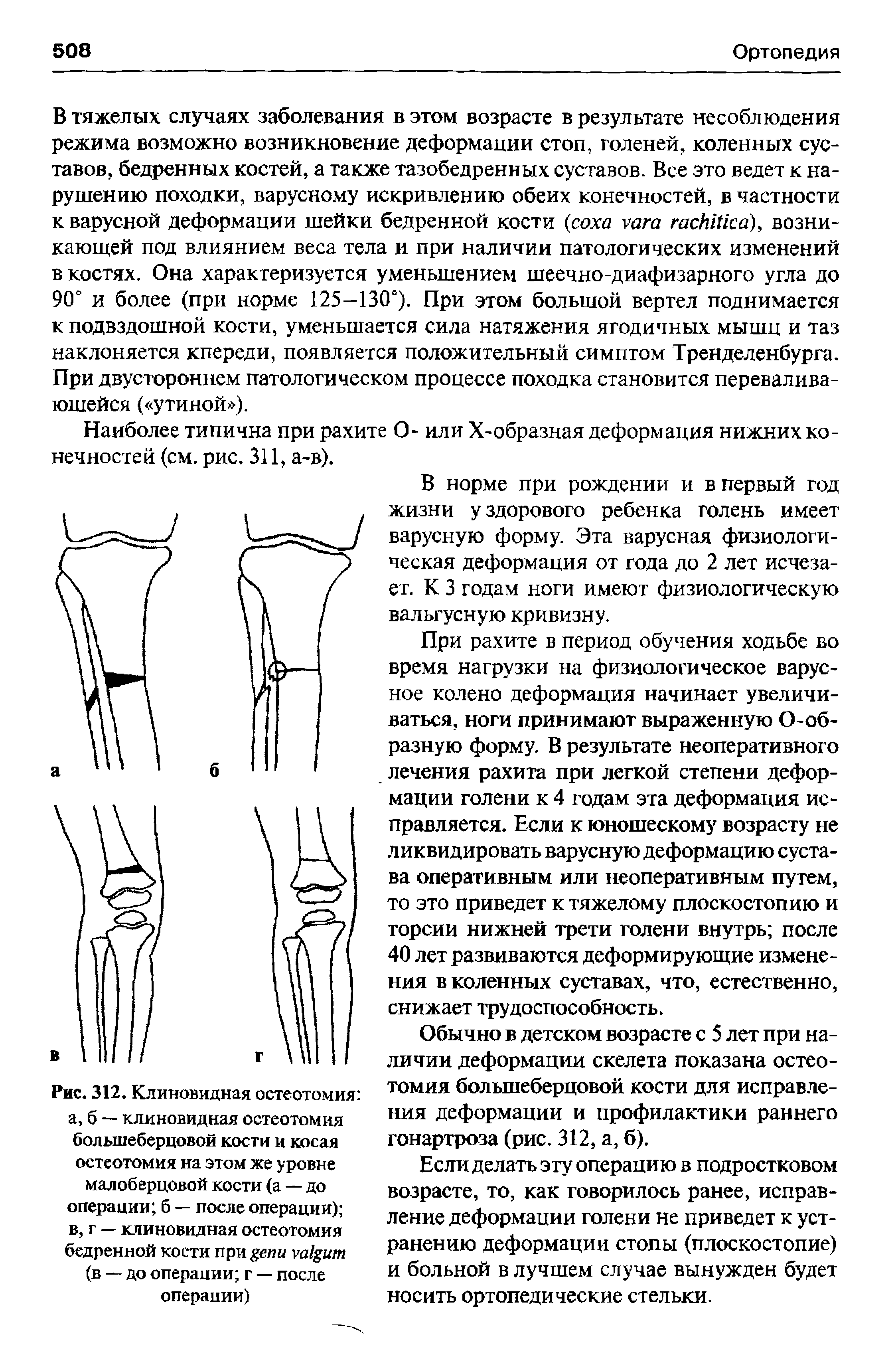 Рис. 312. Клиновидная остеотомия а, б — клиновидная остеотомия большеберцовой кости и косая остеотомия на этом же уровне малоберцовой кости (а — до операции б — после операции) в, г — клиновидная остеотомия бедренной кости при (в — до операции г — после операции)...