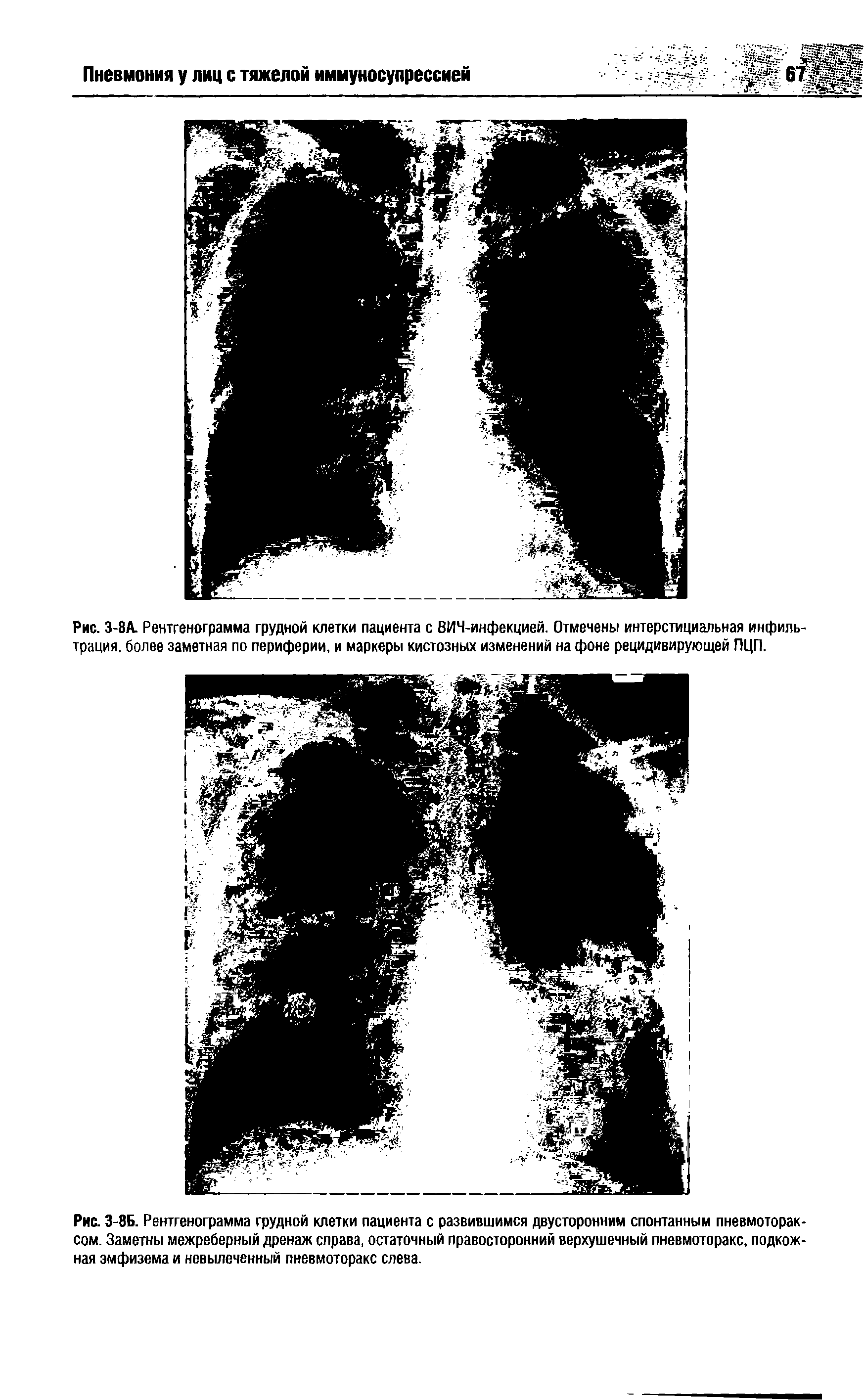 Рис. 3-8Б. Рентгенограмма грудной клетки пациента с развившимся двусторонним спонтанным пневмотораксом. Заметны межреберный дренаж справа, остаточный правосторонний верхушечный пневмоторакс, подкожная эмфизема и невыпеченный пневмоторакс слева.