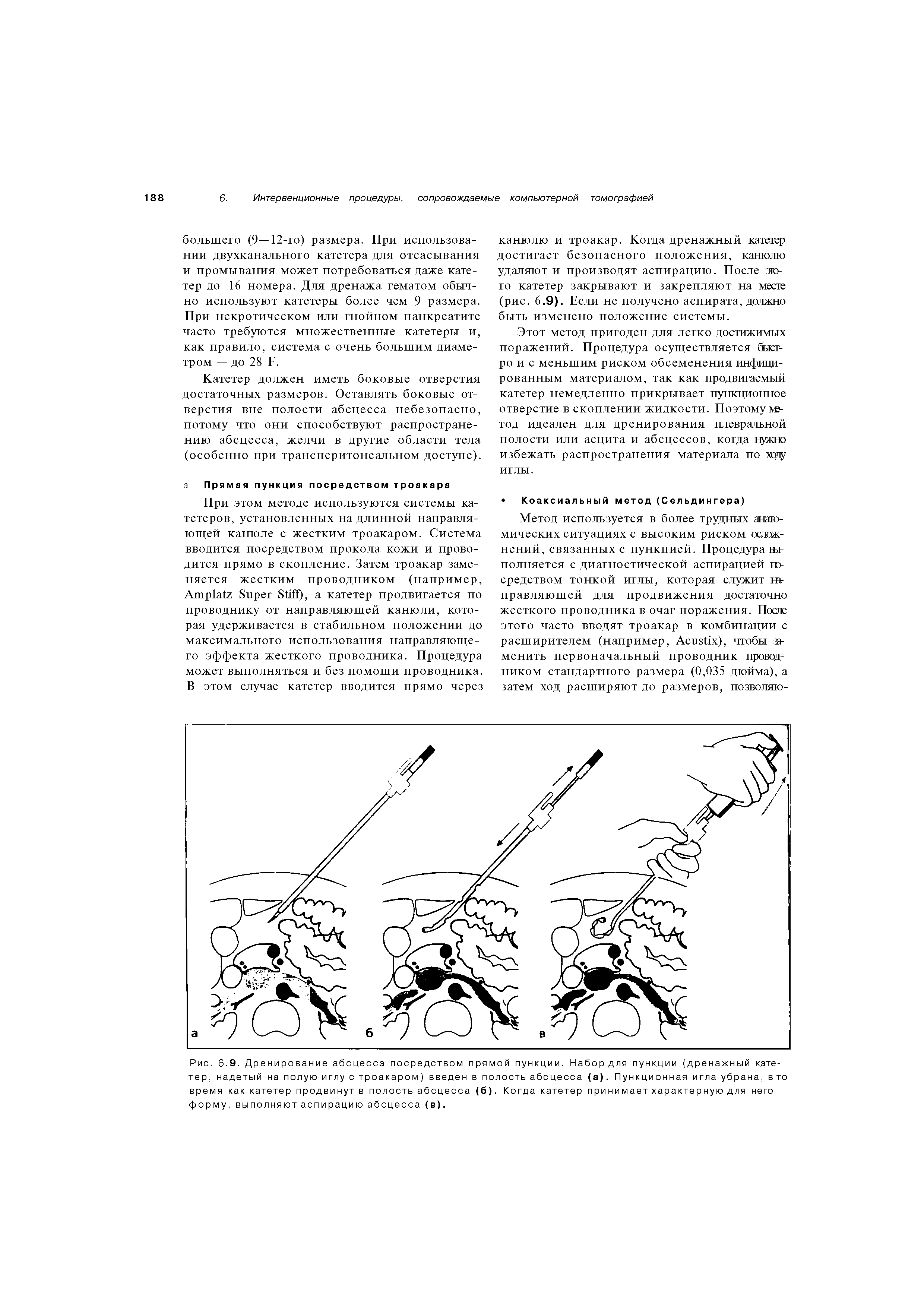 Рис. 6.9. Дренирование абсцесса посредством прямой пункции. Набор для пункции (дренажный катетер, надетый на полую иглу с троакаром) введен в полость абсцесса (а). Пункционная игла убрана, в то время как катетер продвинут в полость абсцесса (б). Когда катетер при ни мает характерную для него форму, выполняют аспирацию абсцесса (в).