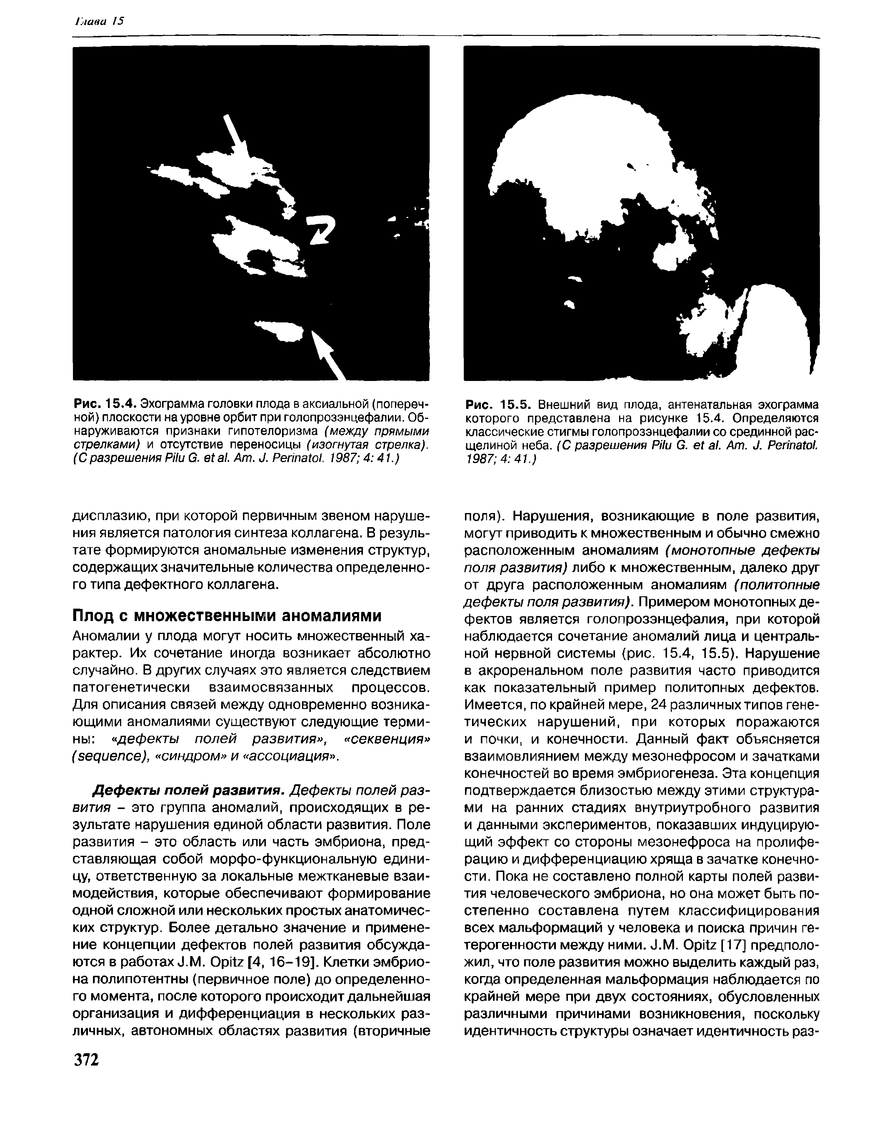 Рис. 15.4. Эхограмма головки плода в аксиальной (поперечной) плоскости на уровне орбит при голопрозэнцефалии. Обнаруживаются признаки гипотелоризма (между прямыми стрелками) и отсутствие переносицы (изогнутая стрелка). (Сразрешения P G. . A . J. P . 1987 4 41.)...