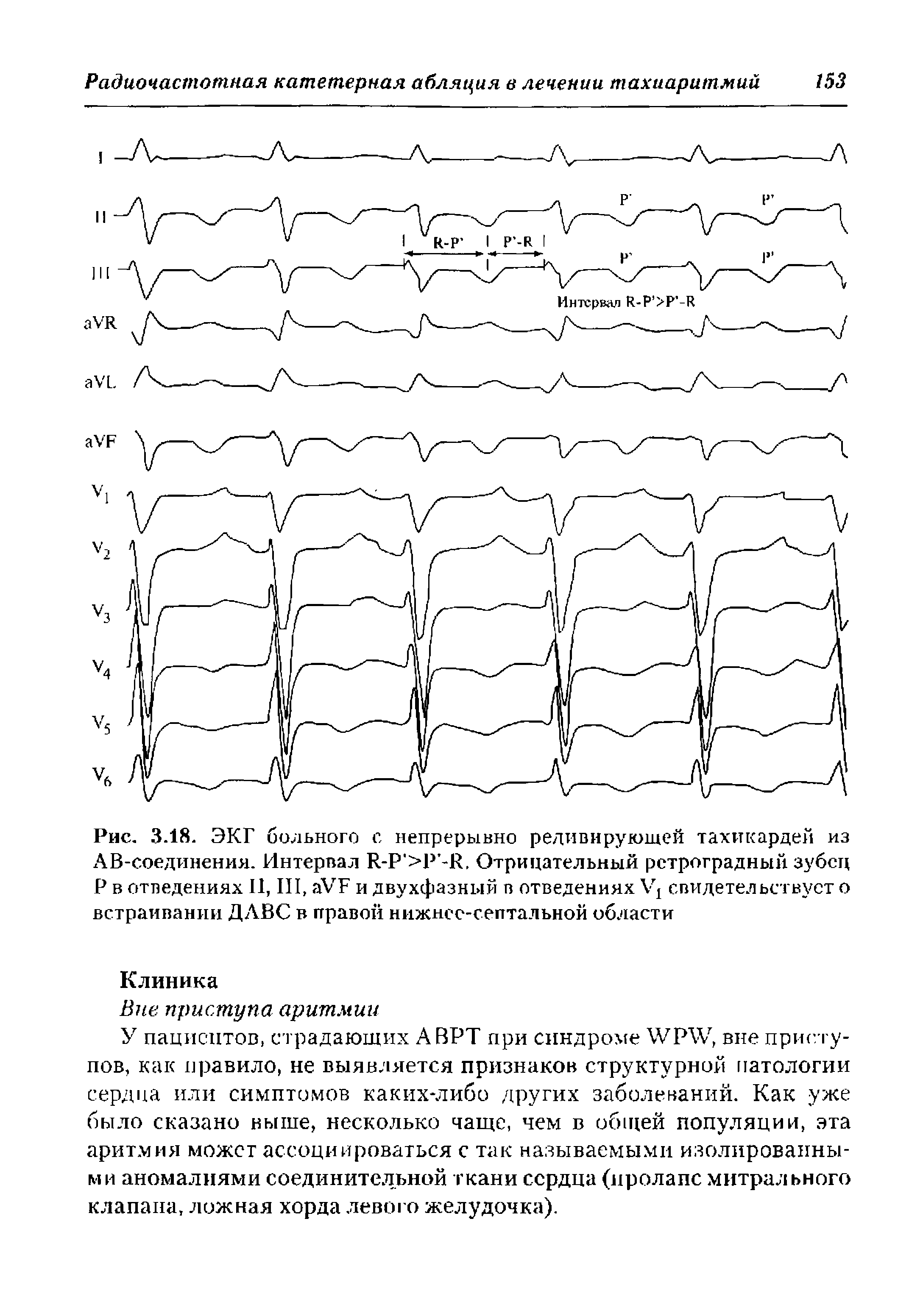 Рис. 3.18. ЭКГ больного с непрерывно редивирующей тахикардей из АВ-соединения. Интервал R-P >P -R, Отрицательный ретроградный зубец Р в отведениях II, III, VF и двухфазный в отведениях свидетельствует о встраивании ДЛВС в правой нижнес-септальной области...