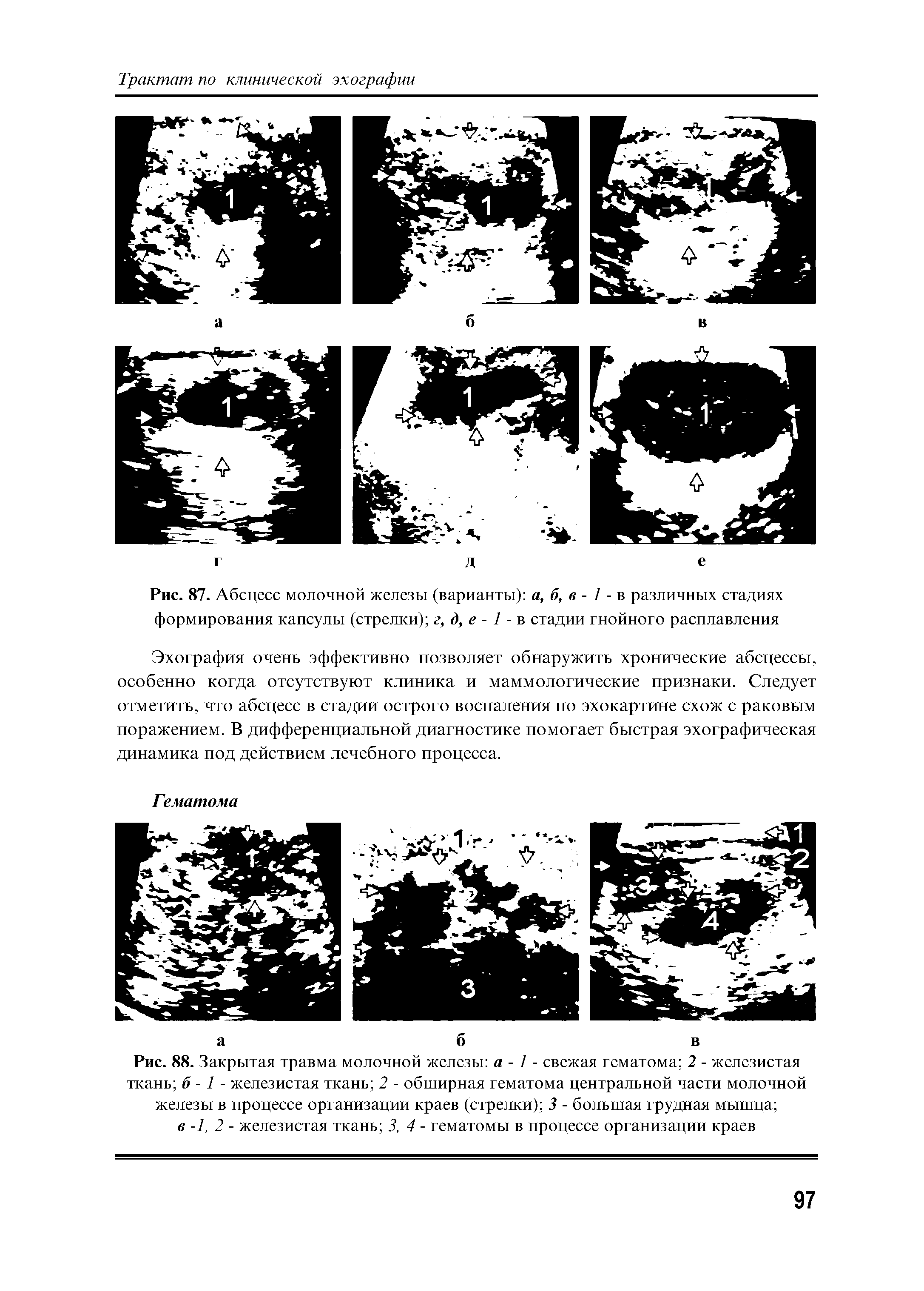 Рис. 87. Абсцесс молочной железы (варианты) а, б, в - 1 - в различных стадиях формирования капсулы (стрелки) г, д, е - 1 - в стадии гнойного расплавления...