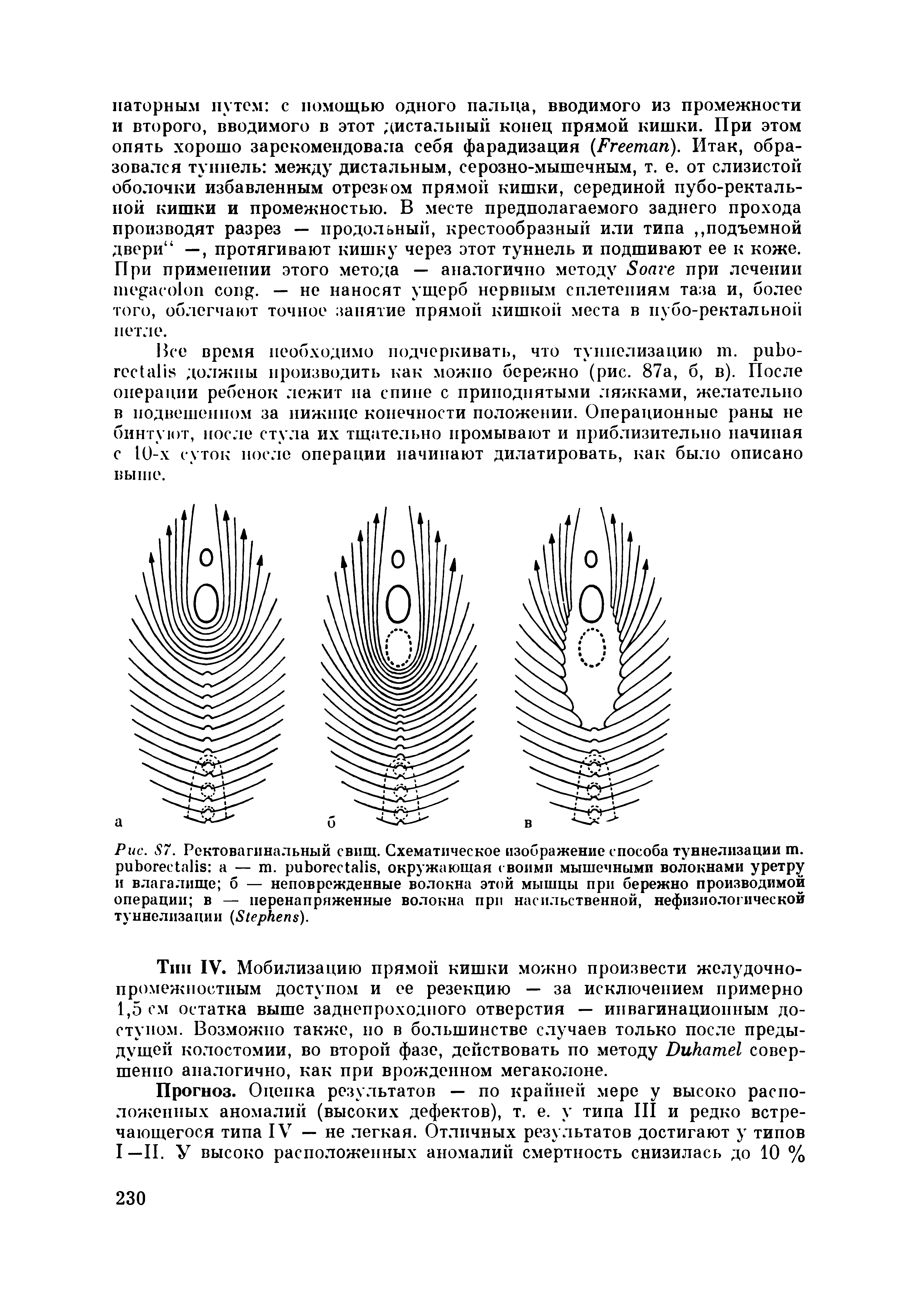 Рис. S7. Ректовагинальный свищ. Схематическое изображение способа туннелизации ш. а — . , окружающая своими мышечными волокнами уретру и влагалище б — неповрежденные волокна этой мышцы при бережно производимой операции в — перенапряженные волокна при насильственной, нефизиологической туннелизации (S ).