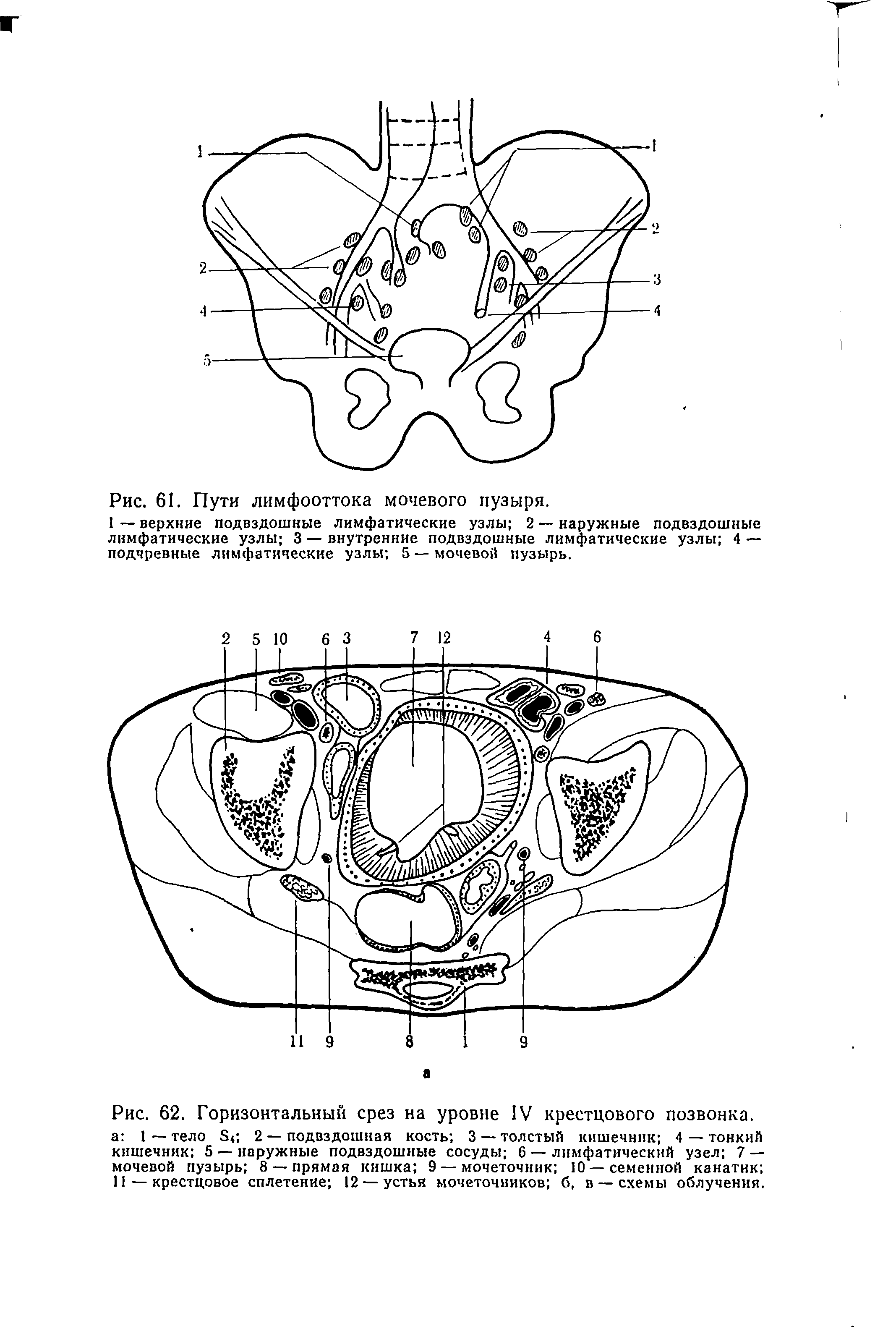 Рис. 62. Горизонтальный срез на уровне IV крестцового позвонка, а 1 — тело 2 — подвздошная кость 3 — толстый кишечник 4 — тонкий кишечник 5 — наружные подвздошные сосуды 6 — лимфатический узел 7 — мочевой пузырь 8 —прямая кишка 9 — мочеточник 10 —семенной канатик 11—крестцовое сплетение 12 — устья мочеточников б, в — схемы облучения.