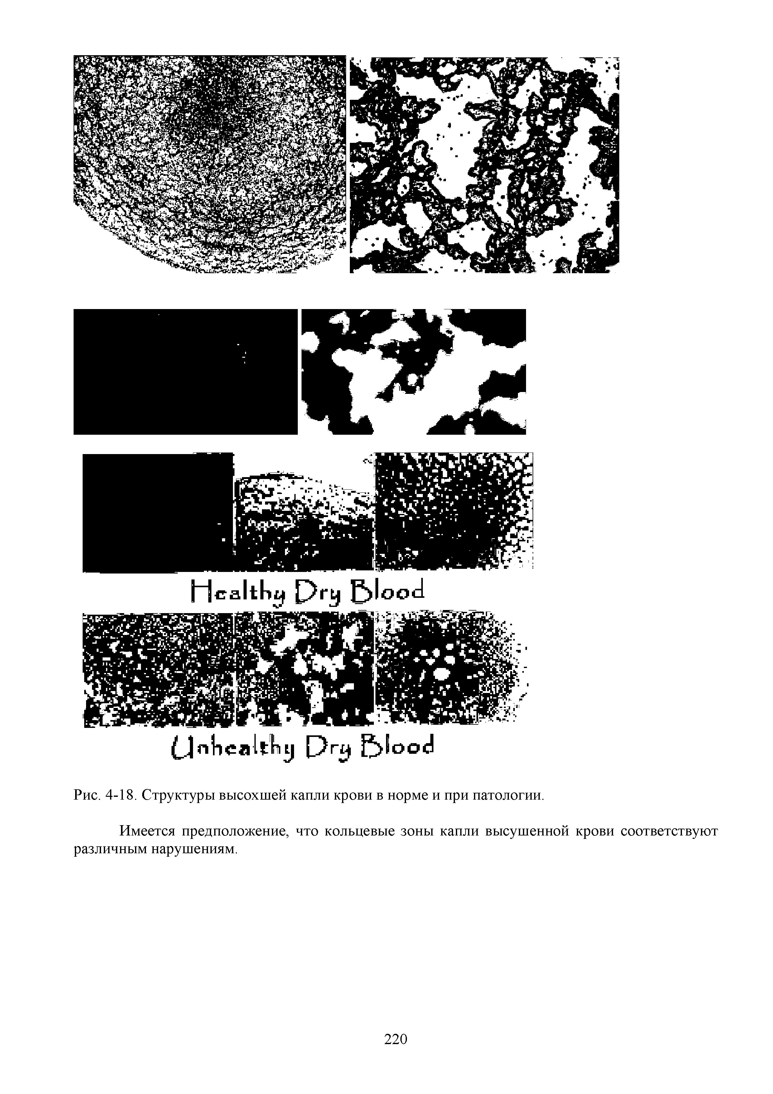 Рис. 4-18. Структуры высохшей капли крови в норме и при патологии.