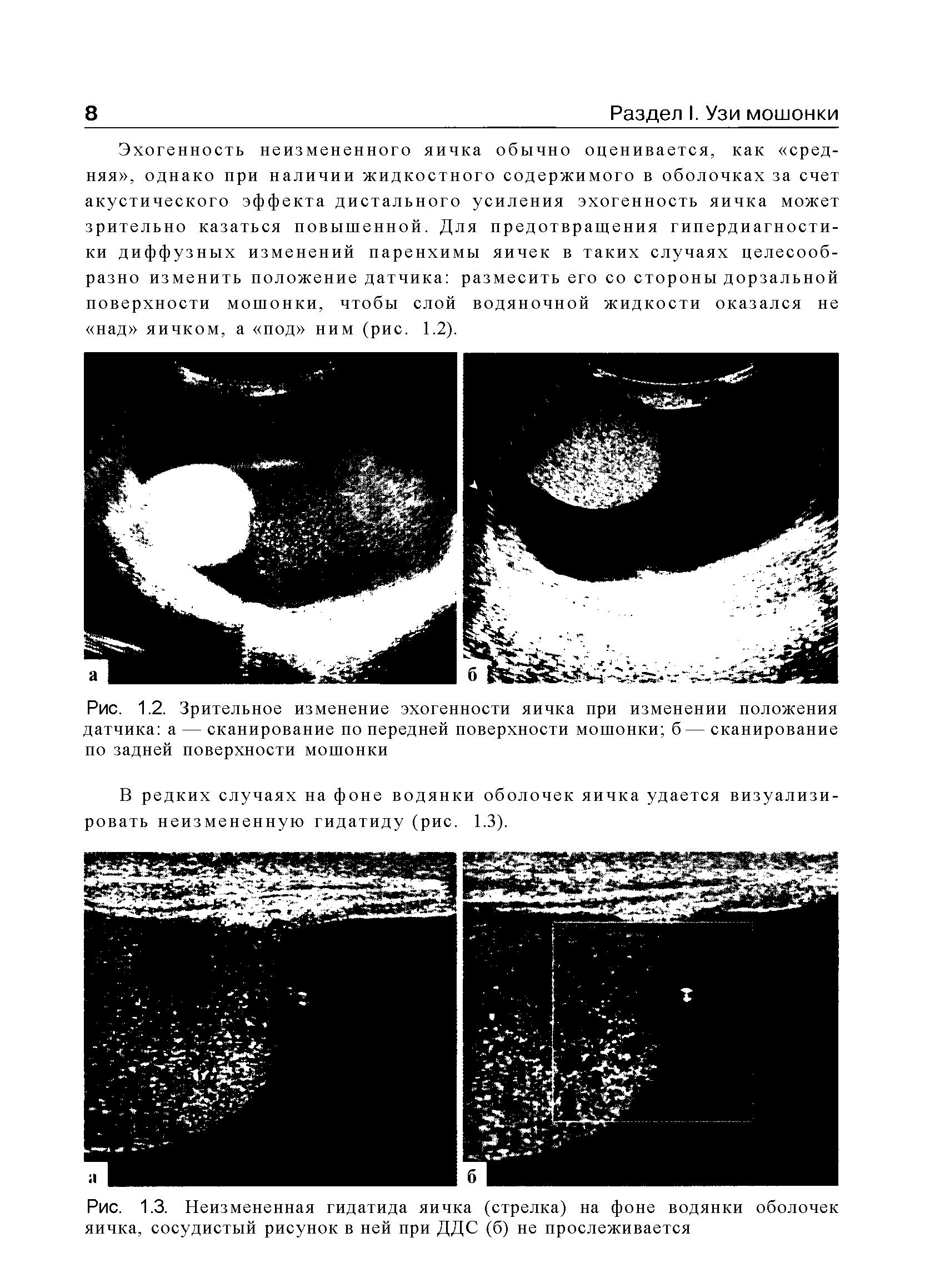 Рис. 1.3. Неизмененная гидатида яичка (стрелка) на фоне водянки оболочек яичка, сосудистый рисунок в ней при ДДС (б) не прослеживается...