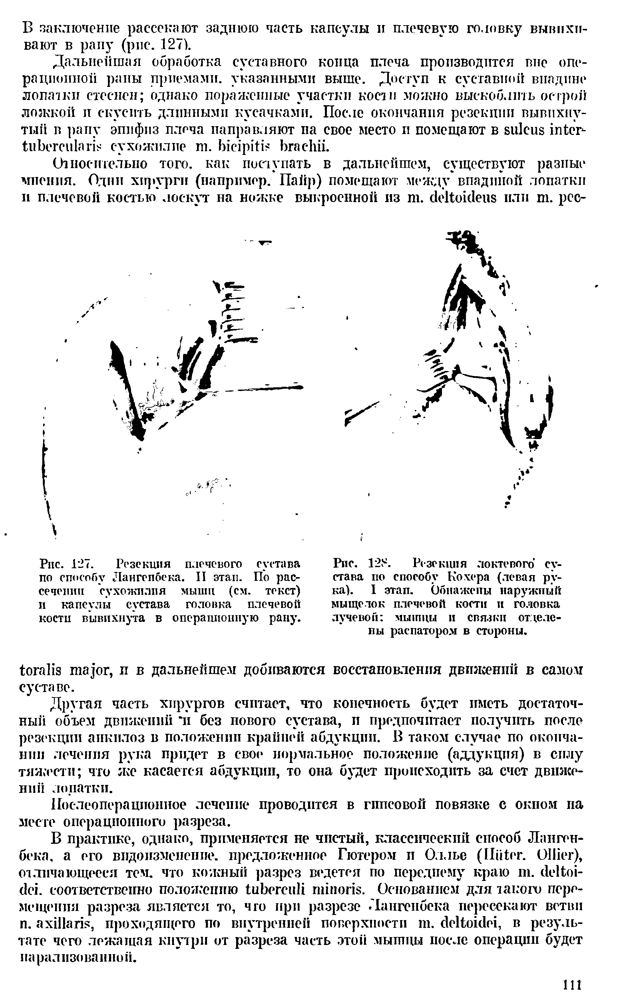 Рис. 127. Резекция плечевого сустава по способу Лангепбека. II этап. По рассечении сухожилия мышц (см. текст) и капсулы сустава головка плечевой кости вывихнута в операционную рану.