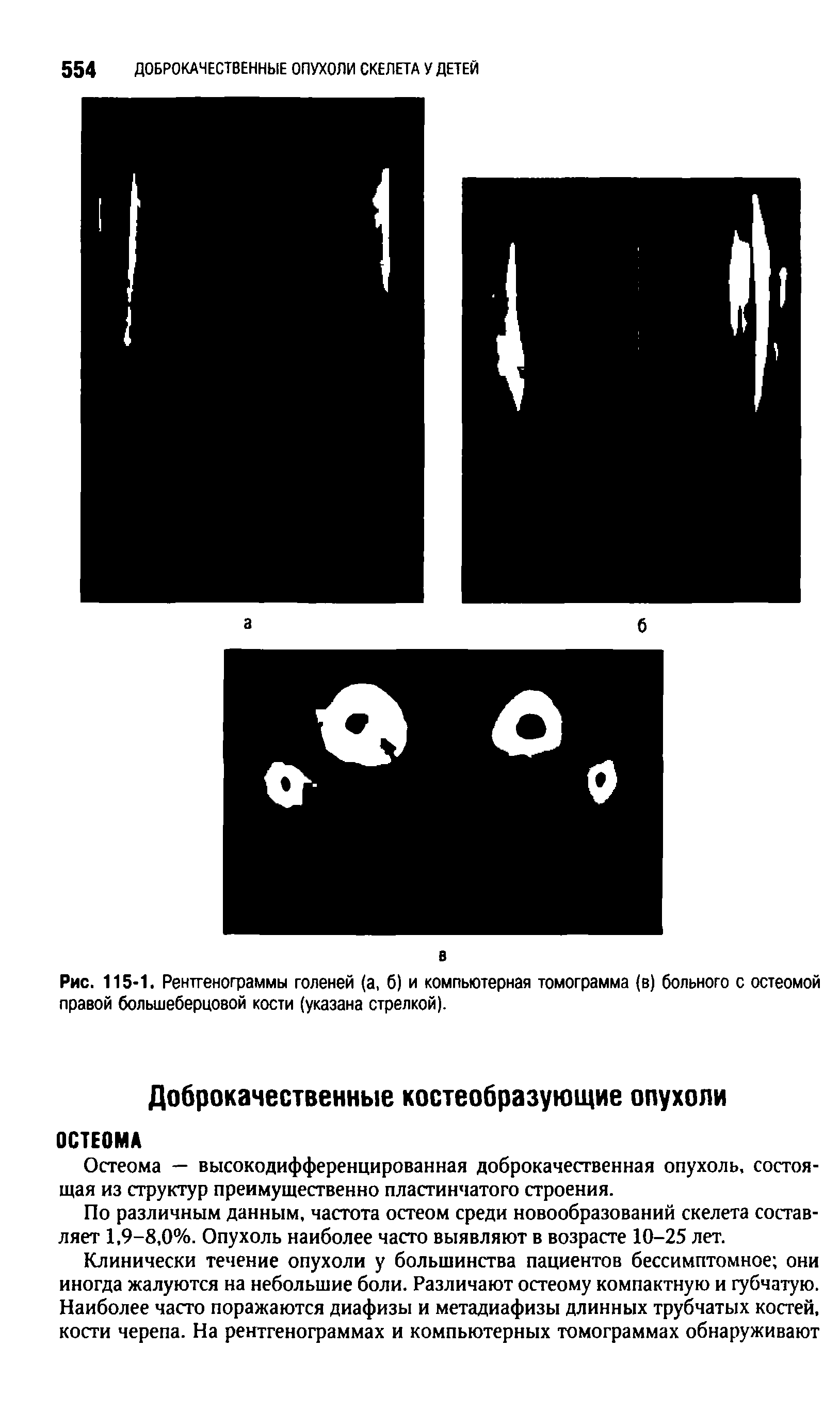 Рис. 115-1. Рентгенограммы голеней (а, б) и компьютерная томограмма (в) больного с остеомой правой большеберцовой кости (указана стрелкой).