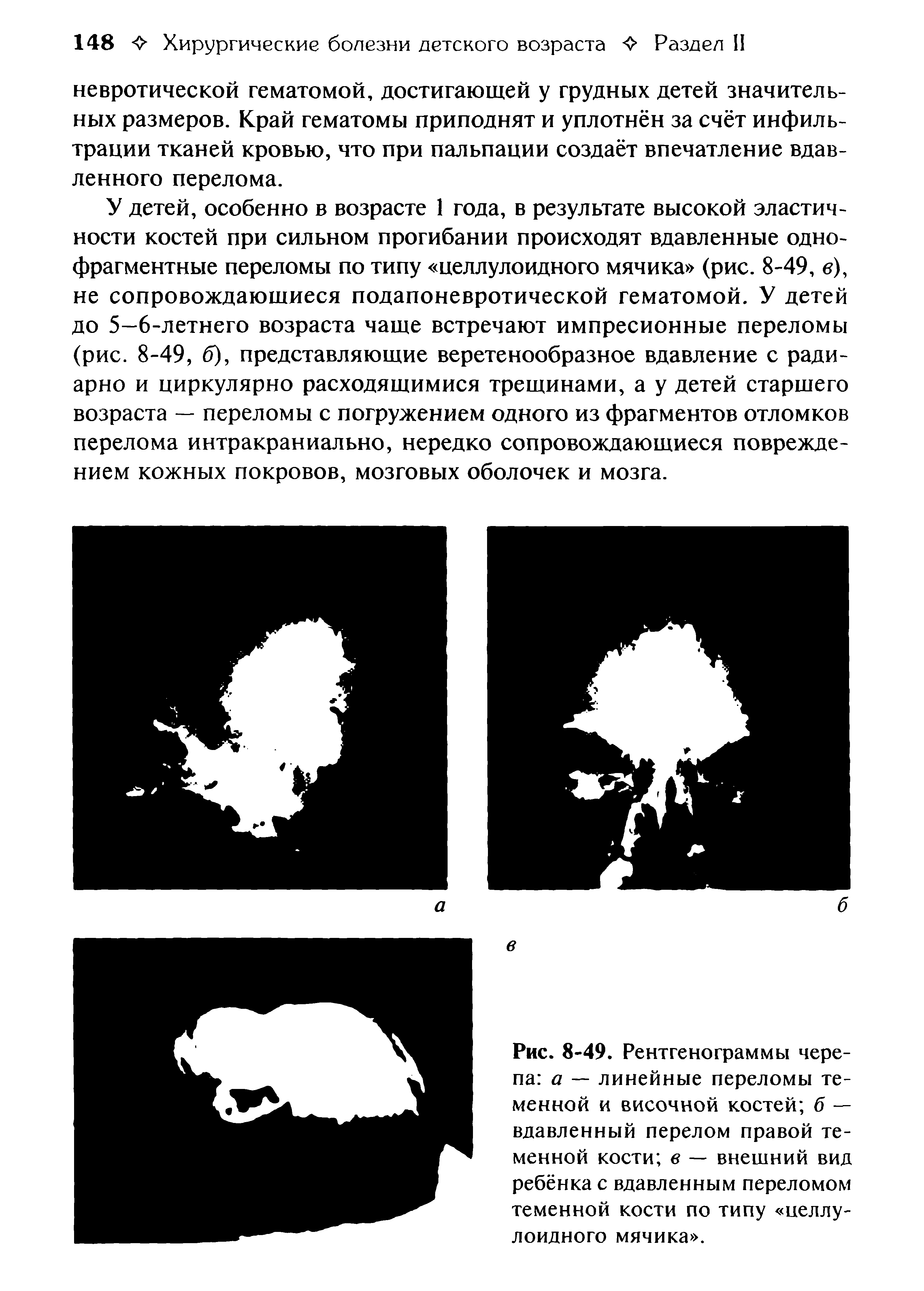 Рис. 8-49. Рентгенограммы черепа а — линейные переломы теменной и височной костей б — вдавленный перелом правой теменной кости в — внешний вид ребёнка с вдавленным переломом теменной кости по типу целлулоидного мячика .