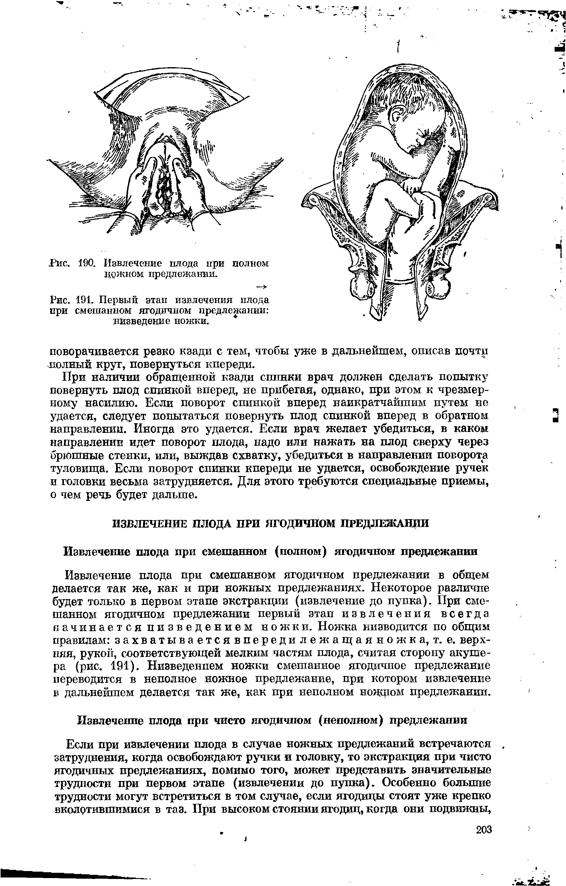 Рис. 191. Первый этап извлечения плода при смешанном ягодичном предлежании низведение ножки. ...