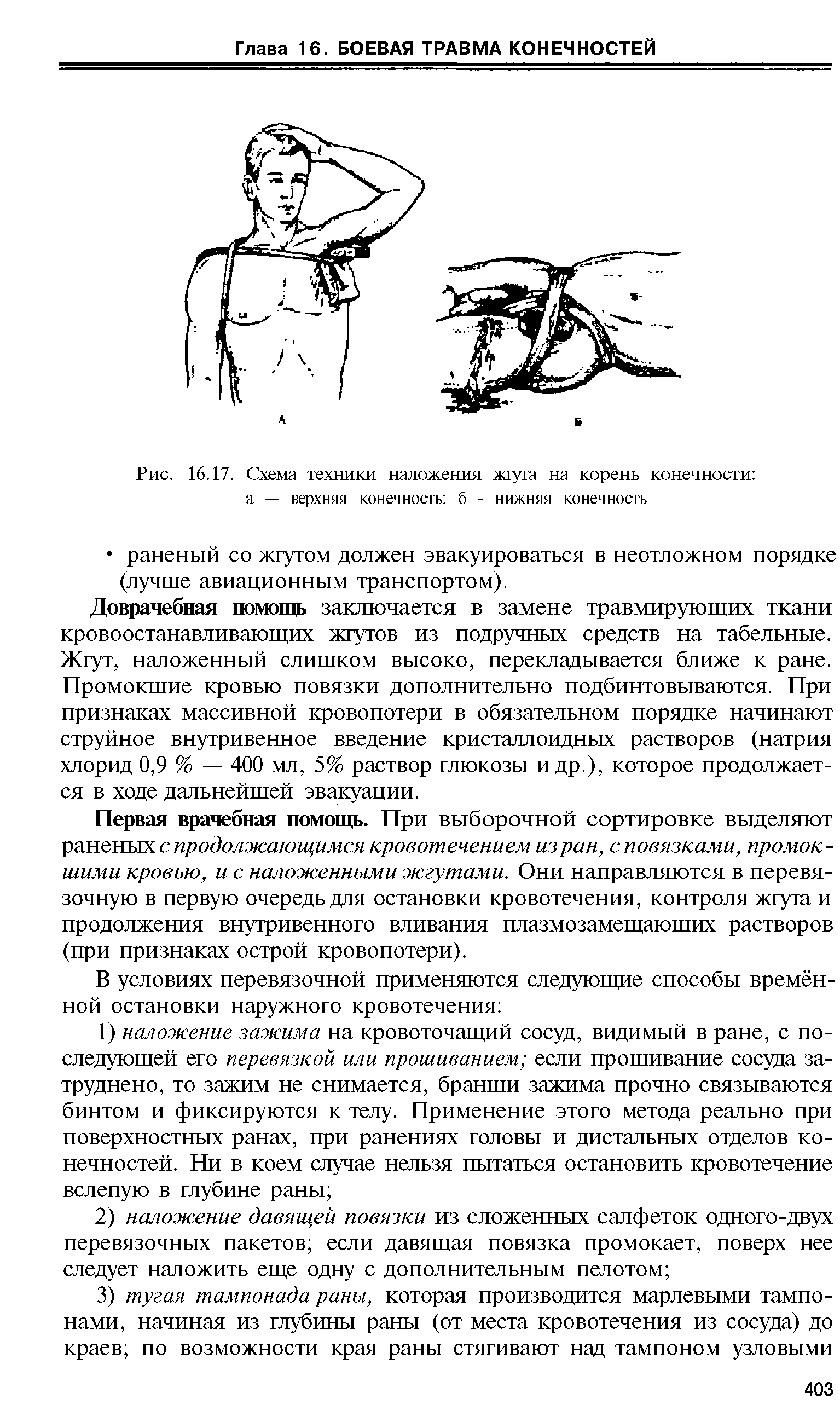 Рис. 16.17. Схема техники наложения жгута на корень конечности ...