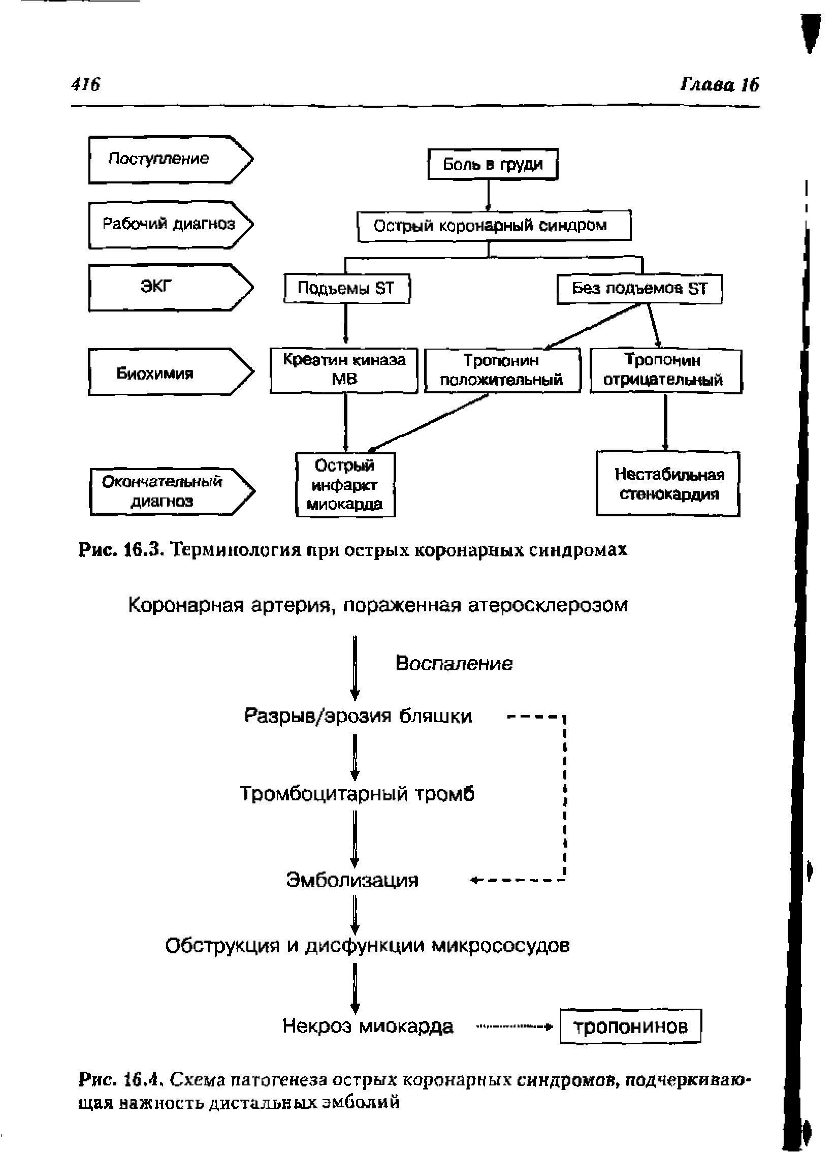 Рис. 16.4. Схема патогенеза острых коронарных синдромов, подчеркивающая важность дистальных эмболий...