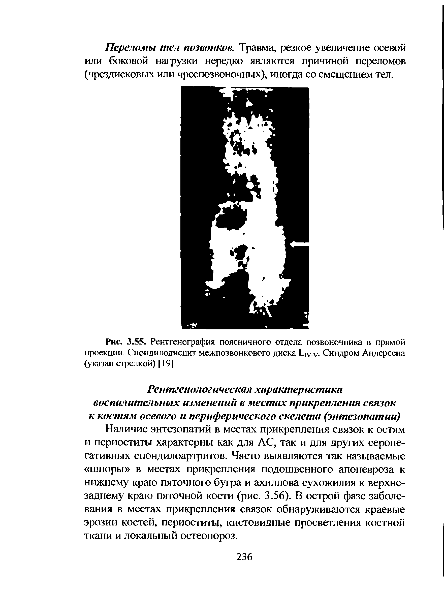 Рис. 3.55. Рентгенография поясничного отдела позвоночника в прямой проекции. Спондилодисцит межпозвонкового диска Цуу Синдром Андерсена (указан стрелкой) [19]...