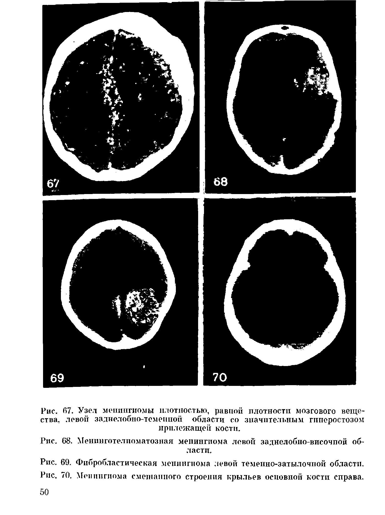 Рис. 69. Фибробластическая менингиома левой теменно-затылочпой области.