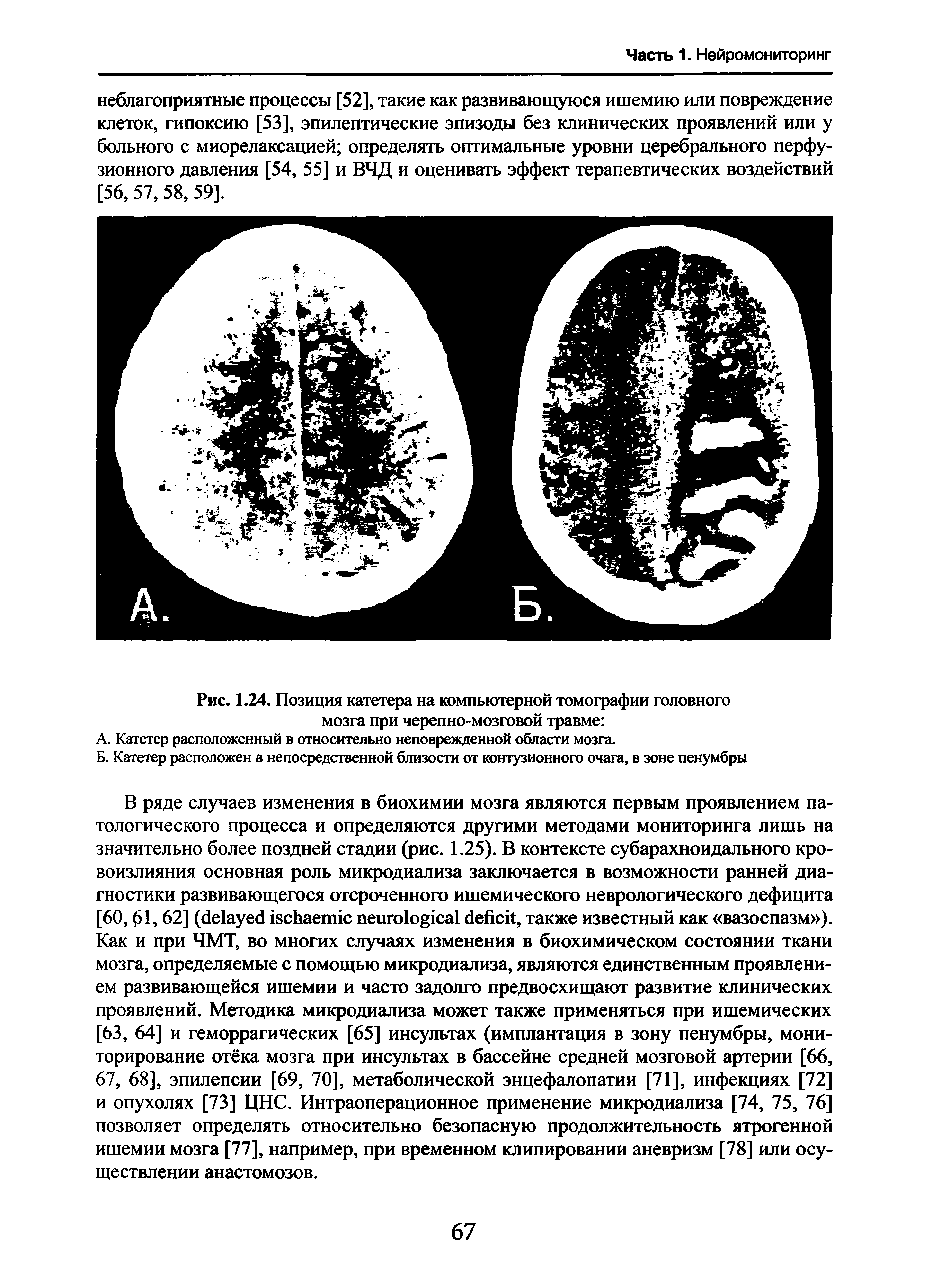Рис. 1.24. Позиция катетера на компьютерной томографии головного мозга при черепно-мозговой травме ...