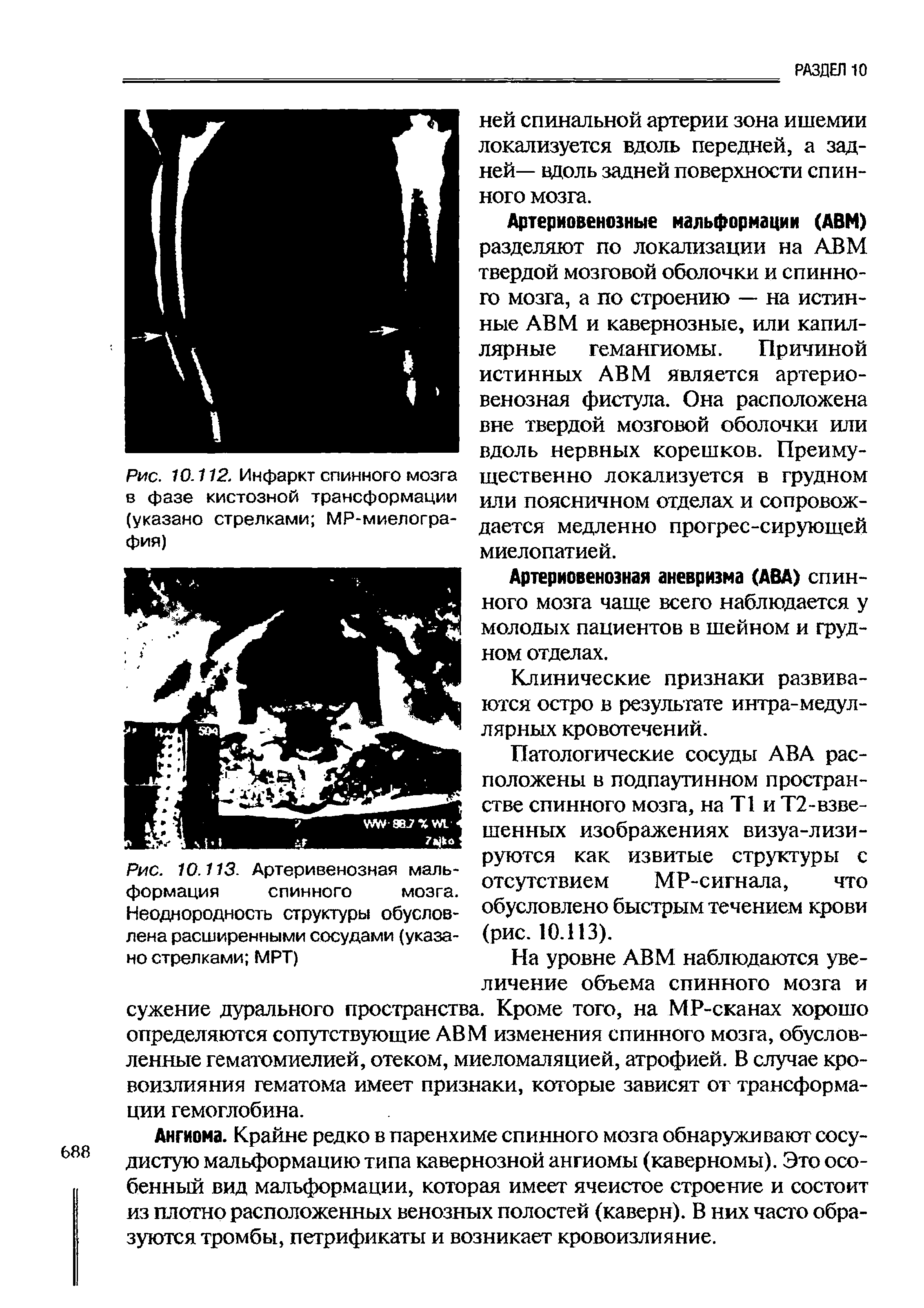 Рис. 10.113. Артеривенозная мальформация спинного мозга. Неоднородность структуры обусловлена расширенными сосудами (указано стрелками МРТ)...