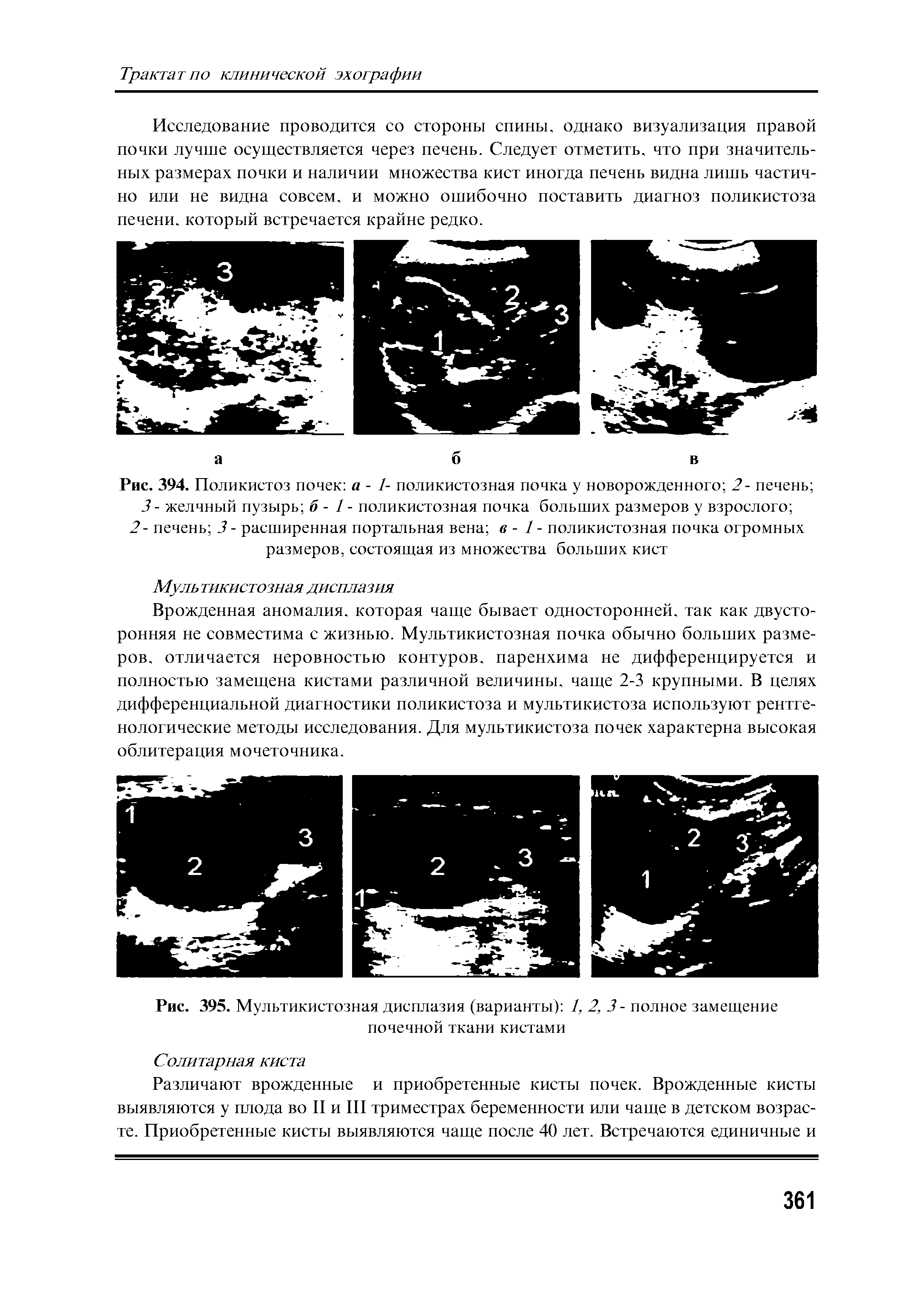 Рис. 395. Мультикистозная дисплазия (варианты) 1, 2, 3 - полное замещение почечной ткани кистами...