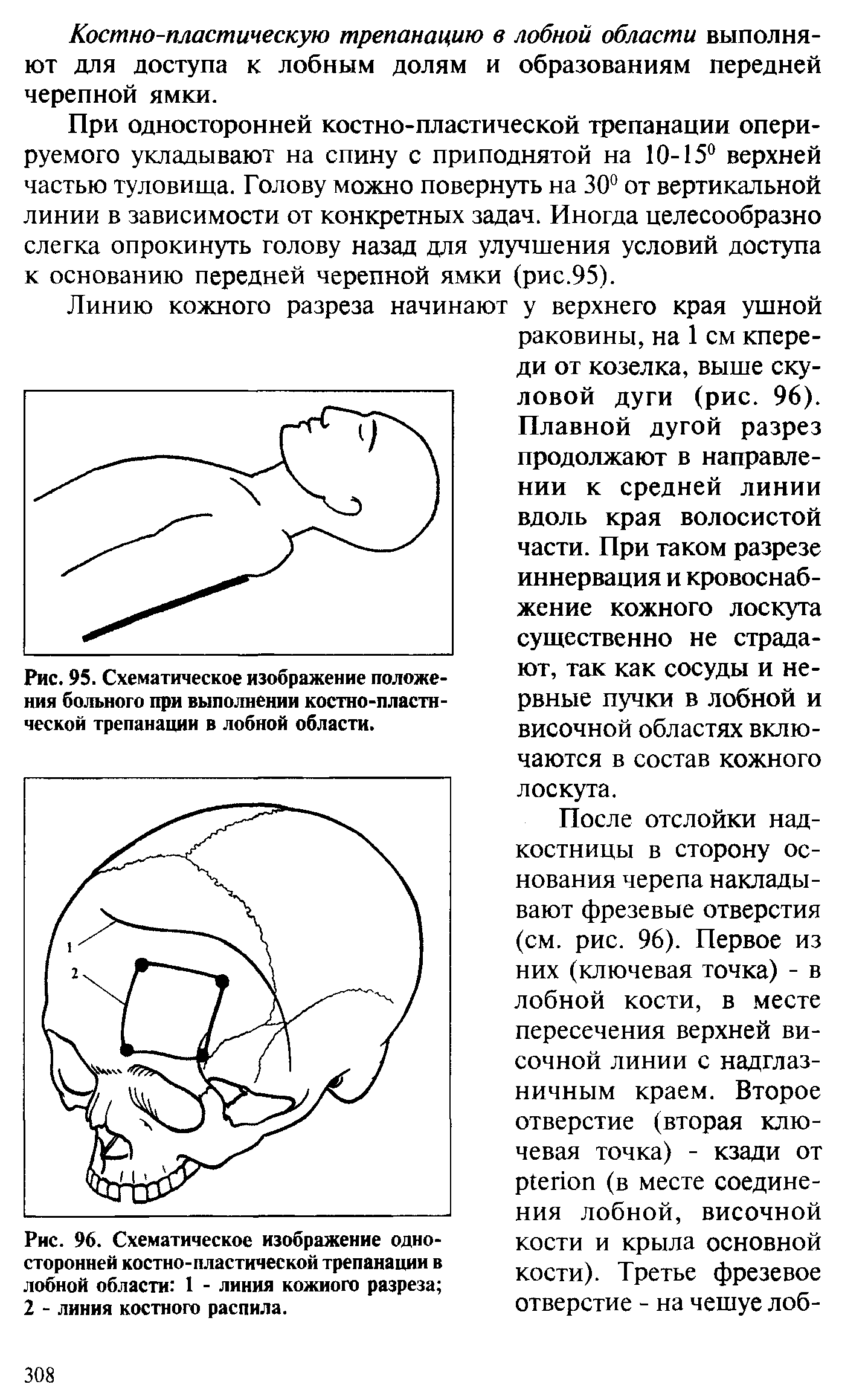 Рис. 96. Схематическое изображение односторонней костно-пластической трепанации в лобной области 1 - линия кожиого разреза 2 - линия костного распила.