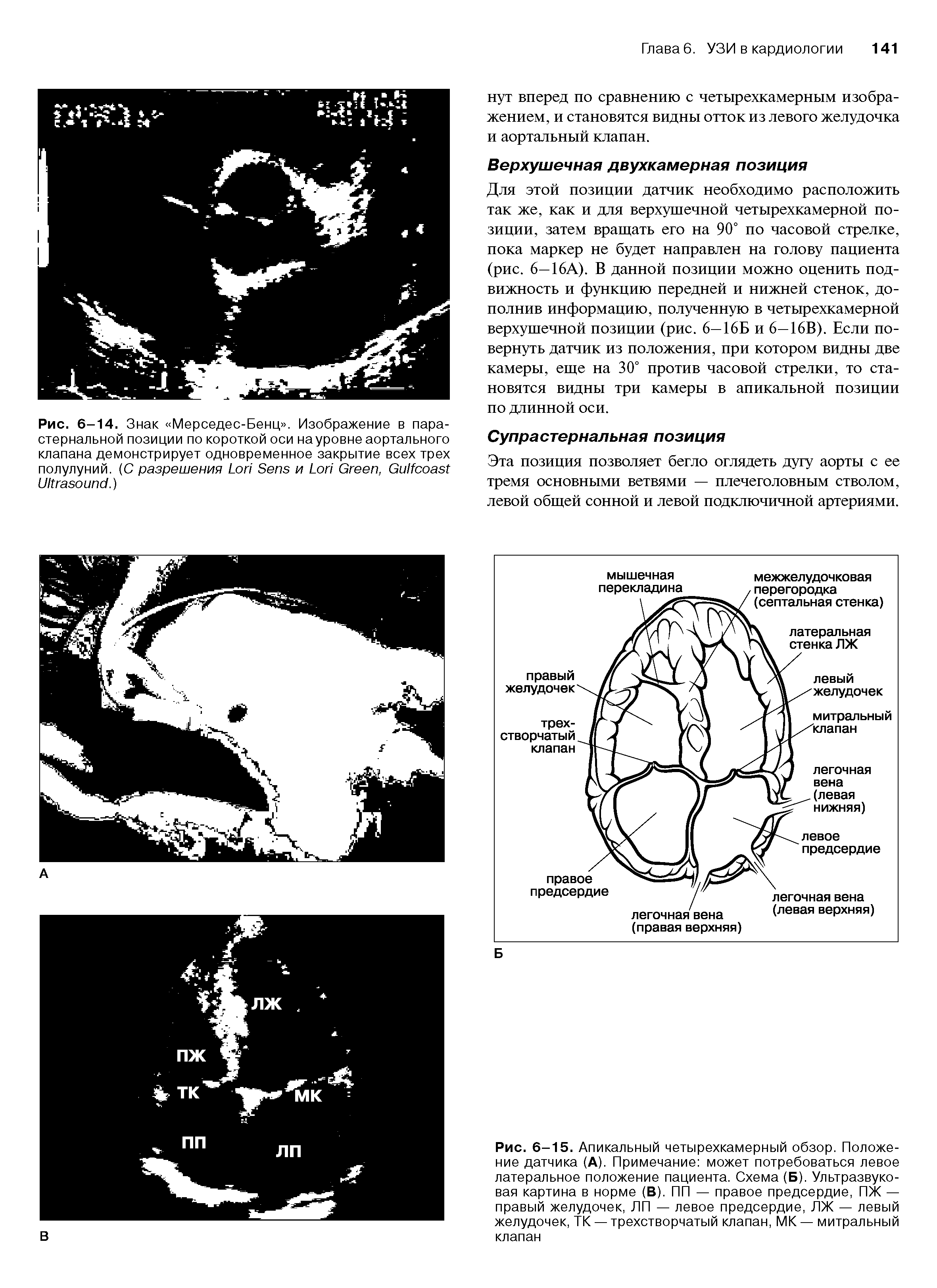 Рис. 6-15. Апикальный четырехкамерный обзор. Положение датчика (А). Примечание может потребоваться левое латеральное положение пациента. Схема (Б). Ультразвуковая картина в норме (В). ПП — правое предсердие, ПЖ — правый желудочек, ЛП — левое предсердие, ЛЖ — левый желудочек, ТК — трехстворчатый клапан, МК— митральный клапан...