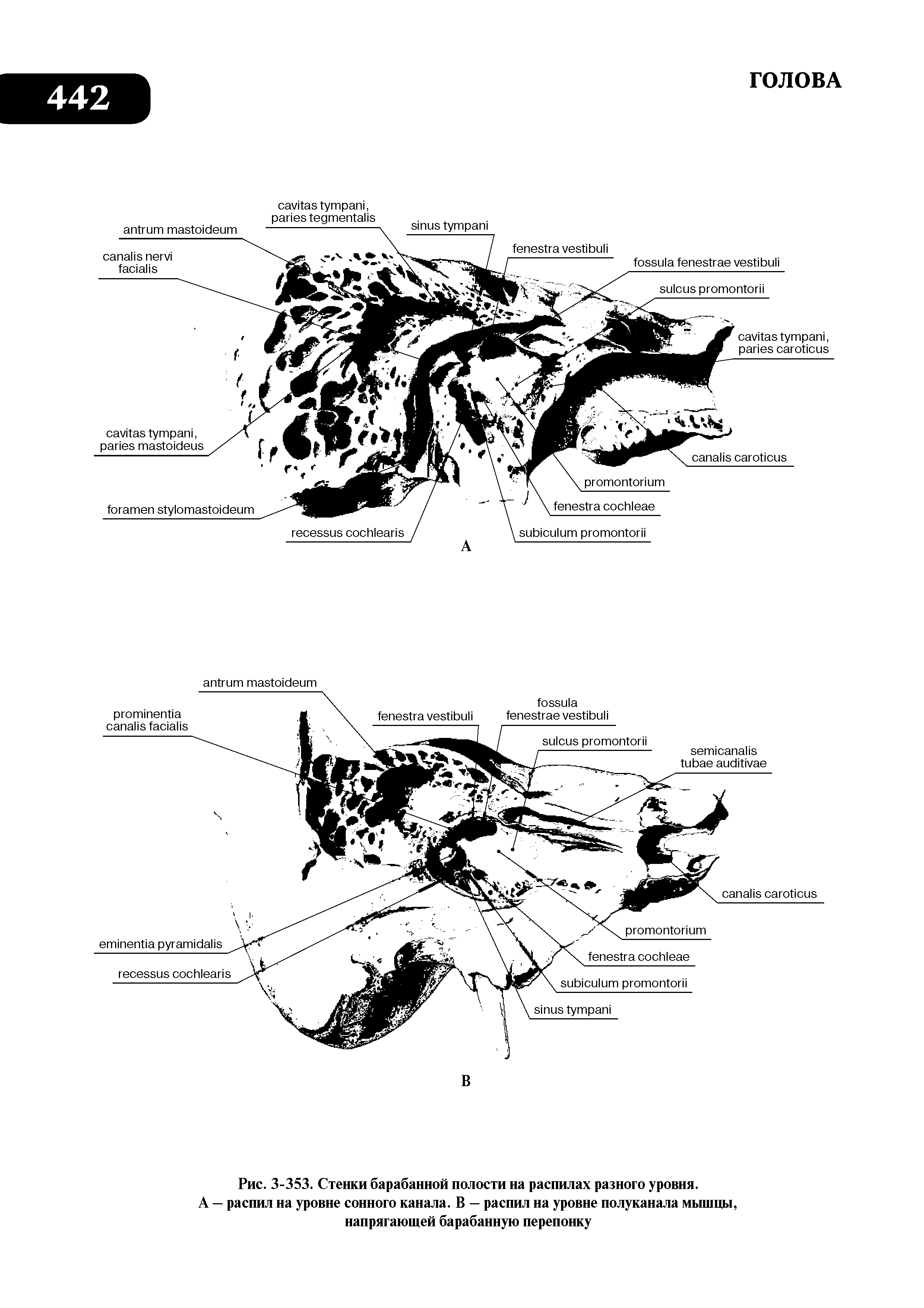 Рис. 3-353. Стенки барабанной полости на распилах разного уровня. А — распил на уровне сонного канала. В — распил на уровне полуканала мышцы, напрягающей барабанную перепонку...