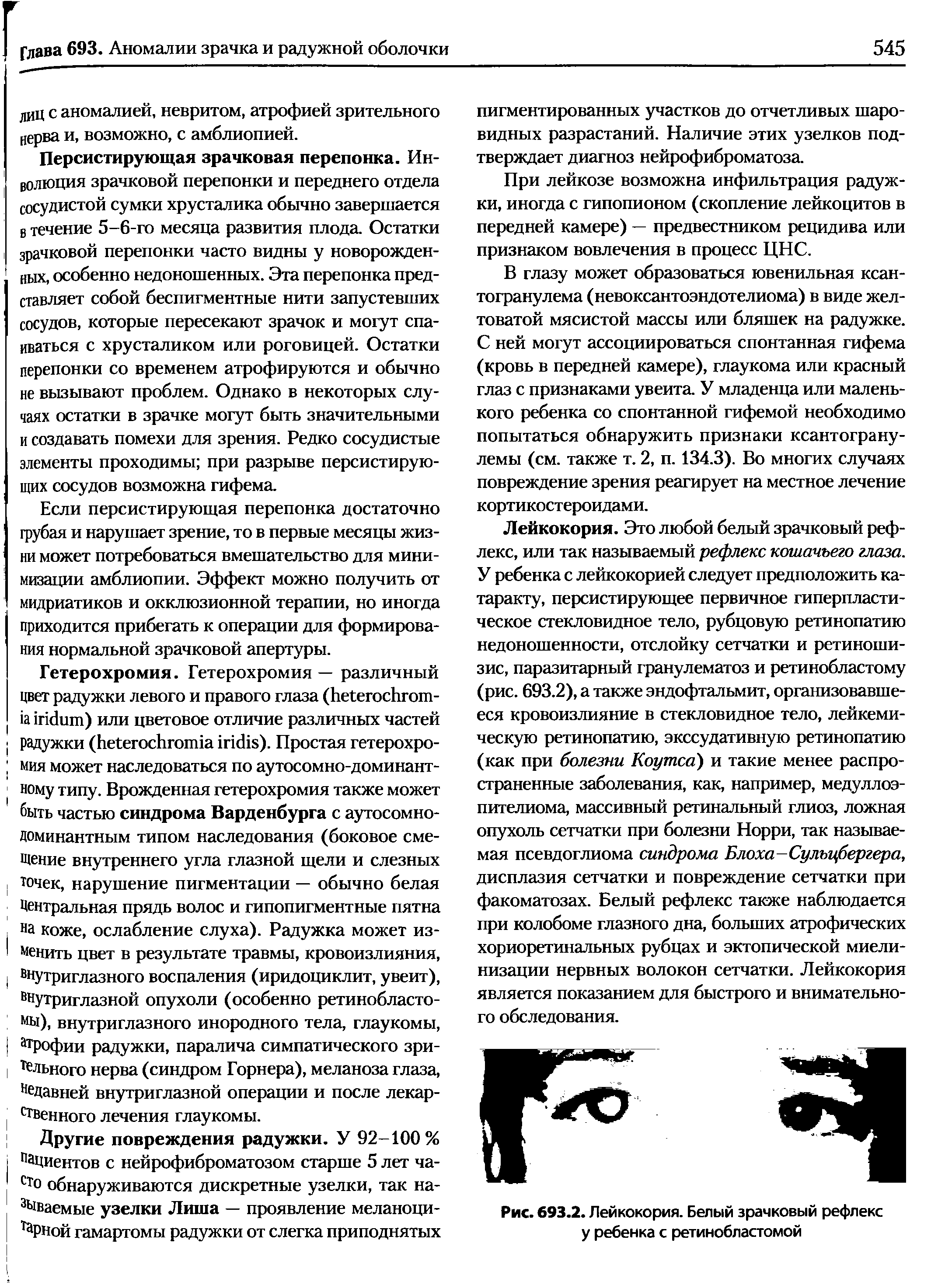 Рис. 693.2. Лейкокория. Белый зрачковый рефлекс у ребенка с ретинобластомой...