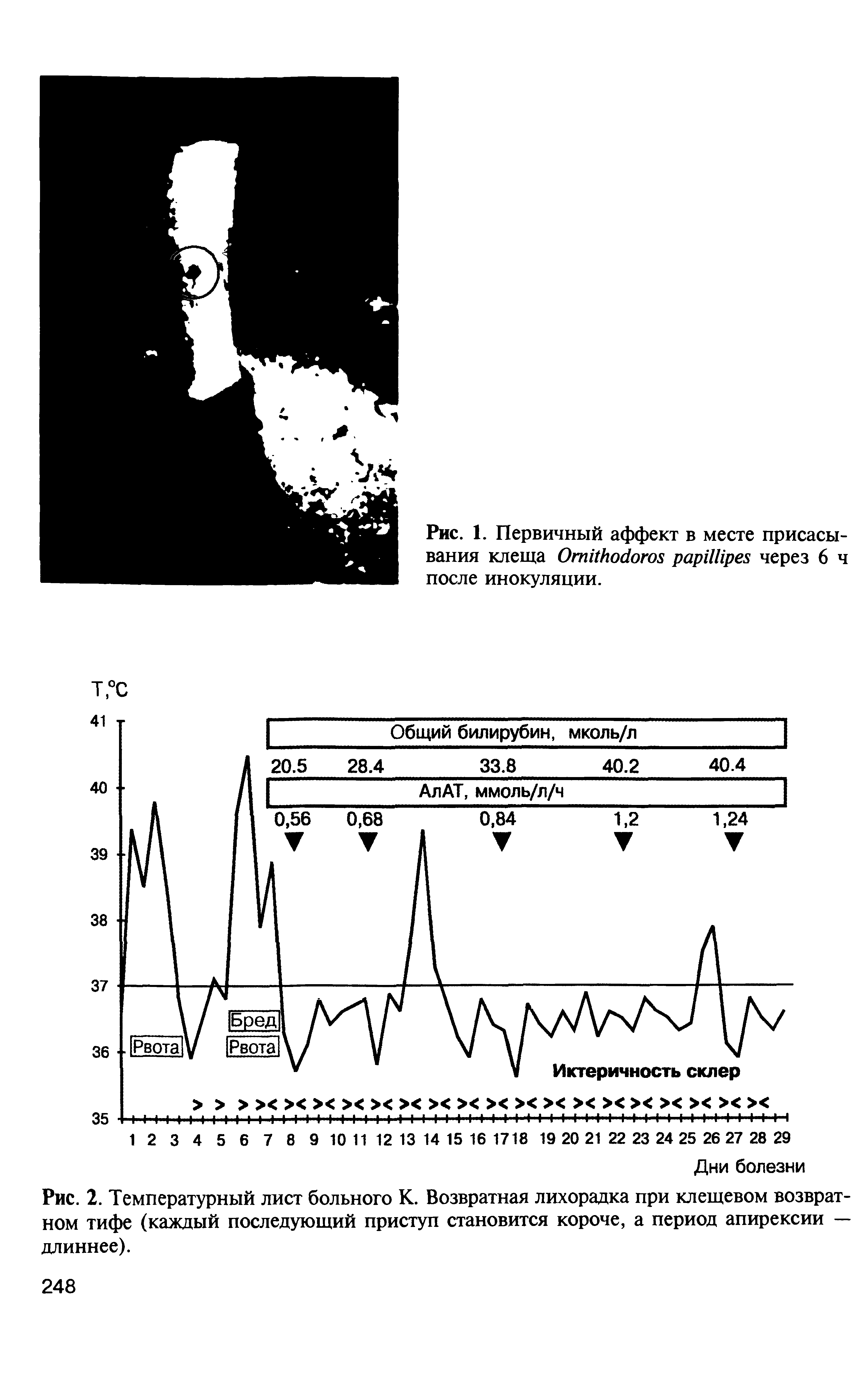 Рис. 2. Температурный лист больного К. Возвратная лихорадка при клещевом возвратном тифе (каждый последующий приступ становится короче, а период апирексии — длиннее).