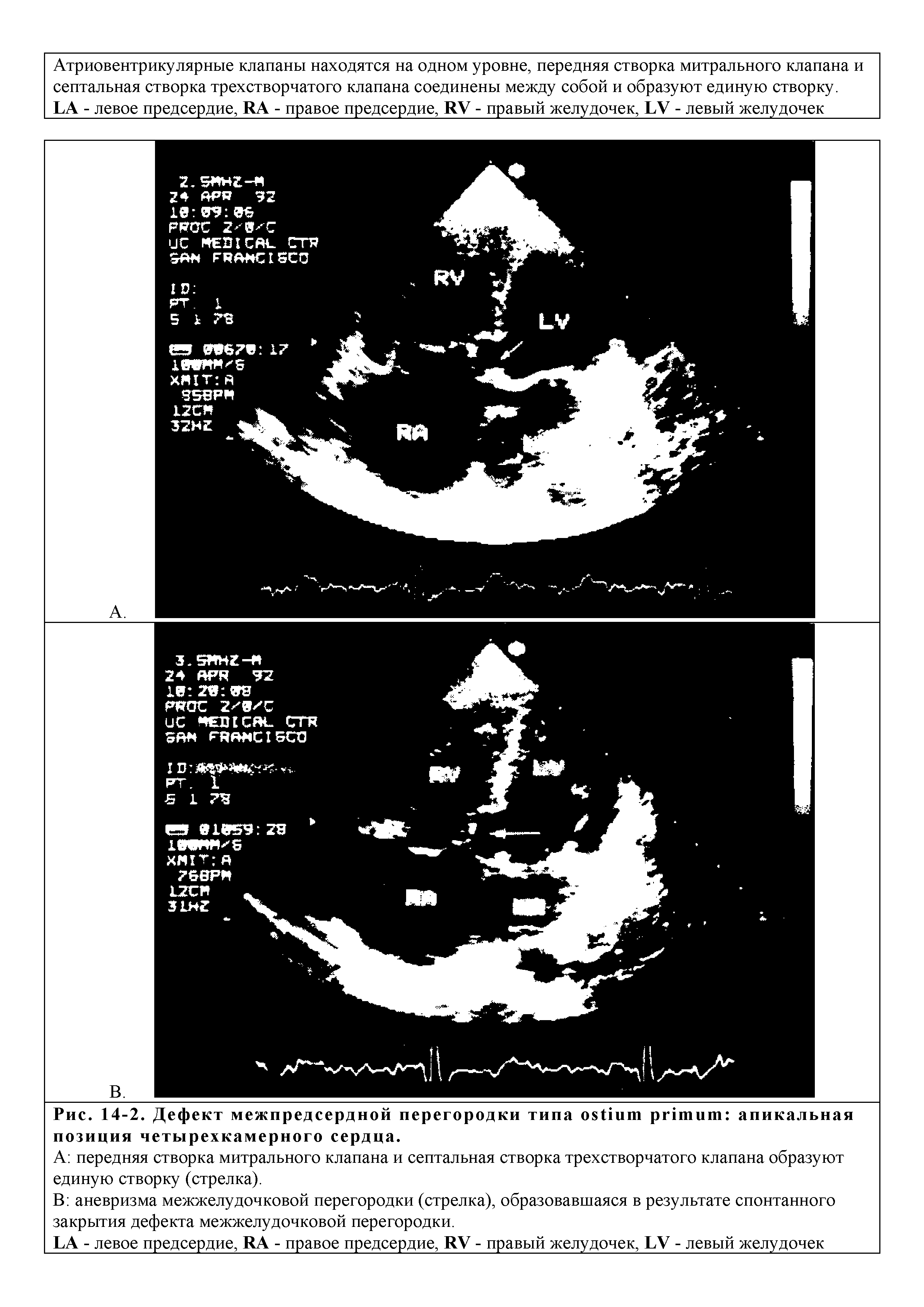 Рис. 14-2. Дефект межпредсердной перегородки типа апикальная позиция четырехкамерного сердца.