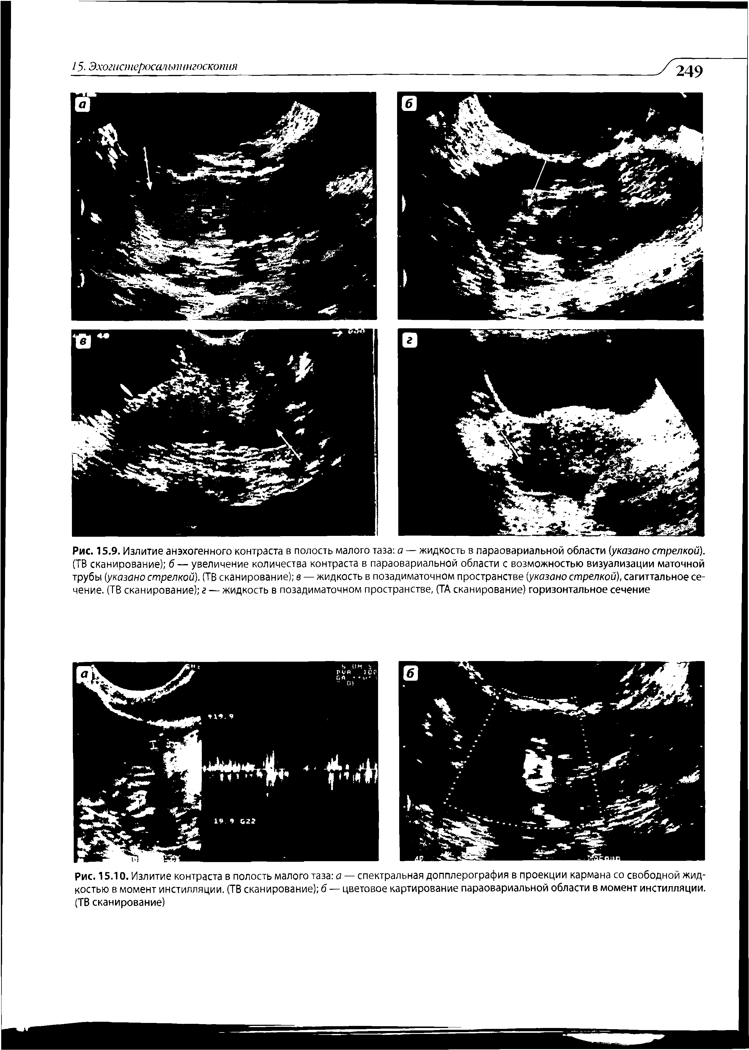 Рис. 15.10. Излитие контраста в полость малого таза а — спектральная допплерография в проекции кармана со свободной жидкостью в момент инстилляции. (ТВ сканирование) б — цветовое картирование параовариальной области в момент инстилляции. (ТВ сканирование)...