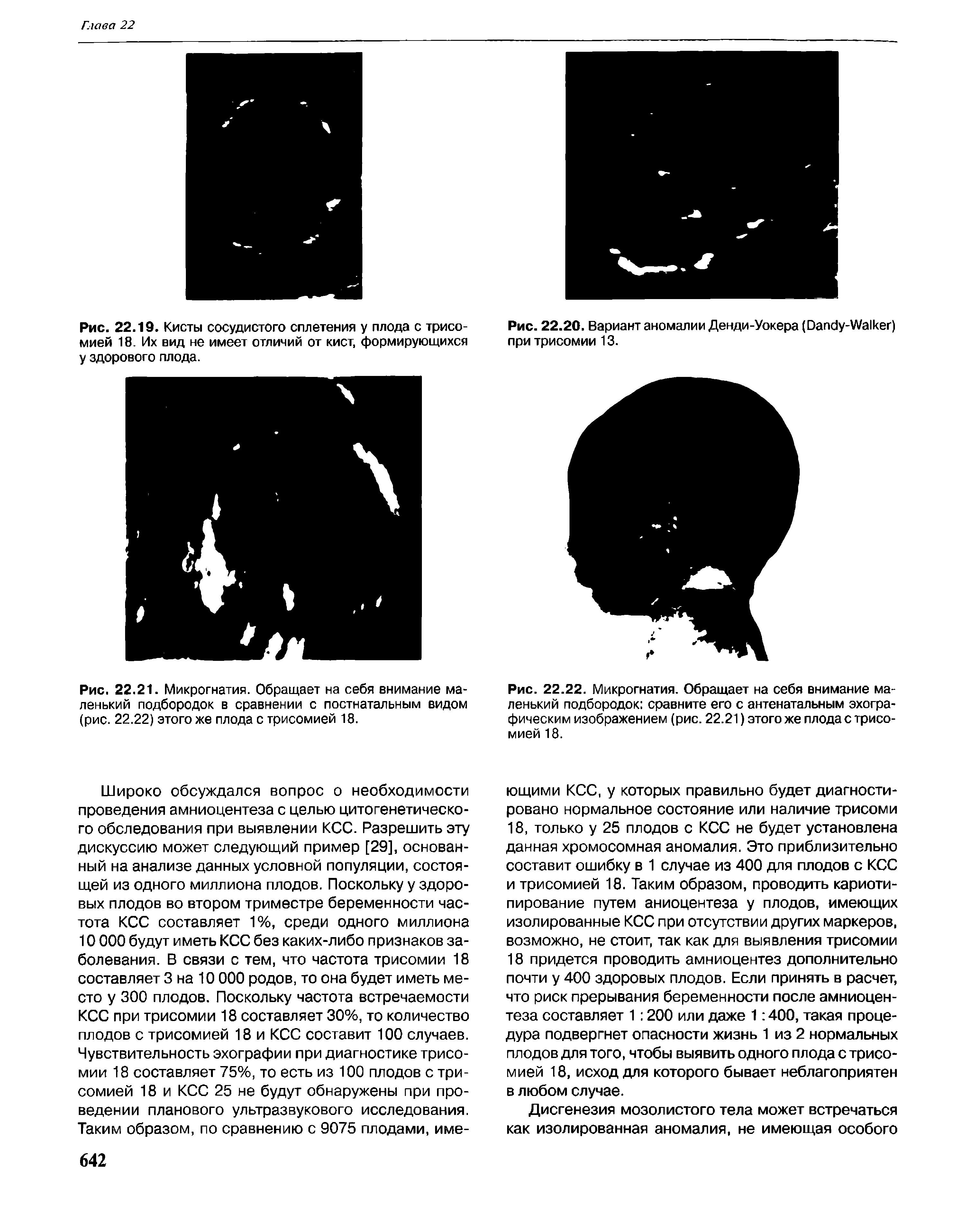 Рис. 22.20. Вариант аномалии Денди-Уокера (D -W ) при трисомии 13.